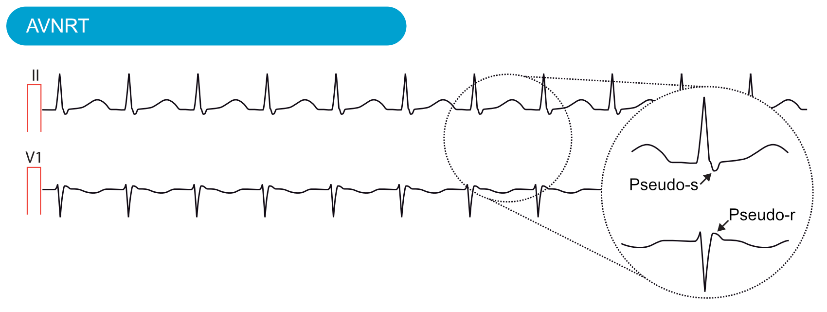 Abbildung 3. AV-Knoten-Reentrytachykardie bei einem 20-jährigen Mann, der unter Herzrasen leidet. Ableitung II: Die retrograde P-Welle direkt nach dem QRS-Komplex imitiert eine S-Zacke, weshalb sie als Pseudo-s bezeichnet wird. Ableitung V1: Die P-Welle ist auch kurz nach dem QRS-Komplex in V1 zu sehen, wo sie eine R-Zacke imitiert, weshalb sie als Pseudo-r bezeichnet wird.