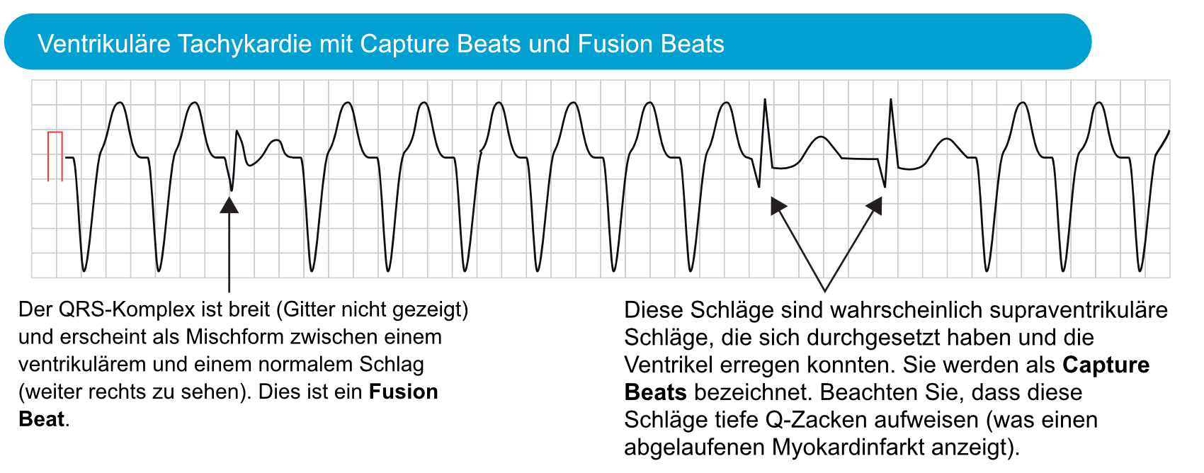 Abbildung 6. Capture Beats und Fusion Beats, die während der ventrikulären Tachykardie beobachtet wurden.