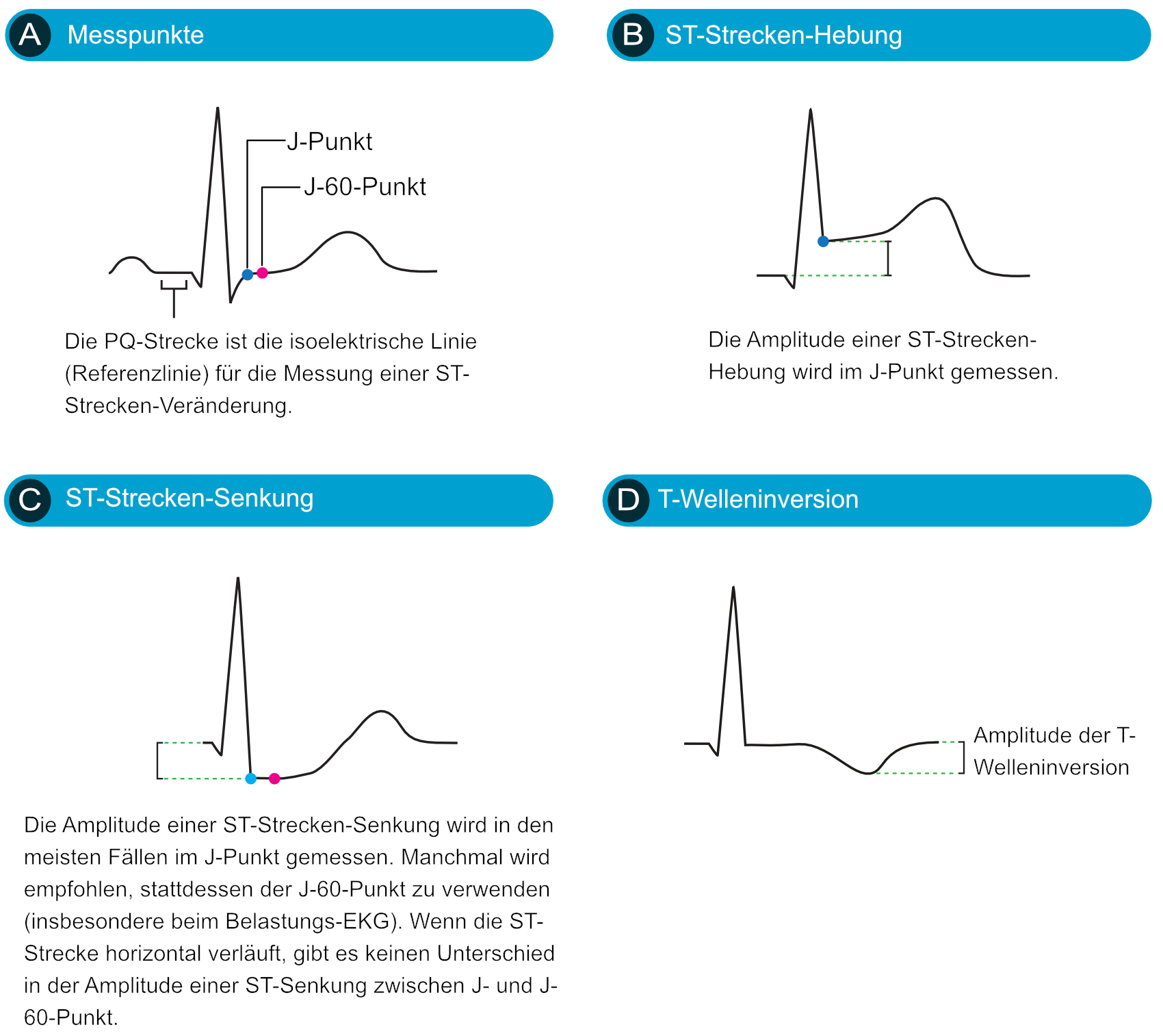 Abbildung 2. Diese Abbildung veranschaulicht ST-Hebung, ST-Senkung und T-Welleninversion. Patienten mit STEMI (STE-ACS) zeigen immer ST-Hebungen, können aber auch ST-Senkungen und/oder T-Welleninversionen aufweisen. Patienten mit NSTE-ACS (NSTEMI, instabile Angina) hingegen weisen nur ST-Senkungen oder T-Welleninversionen auf.