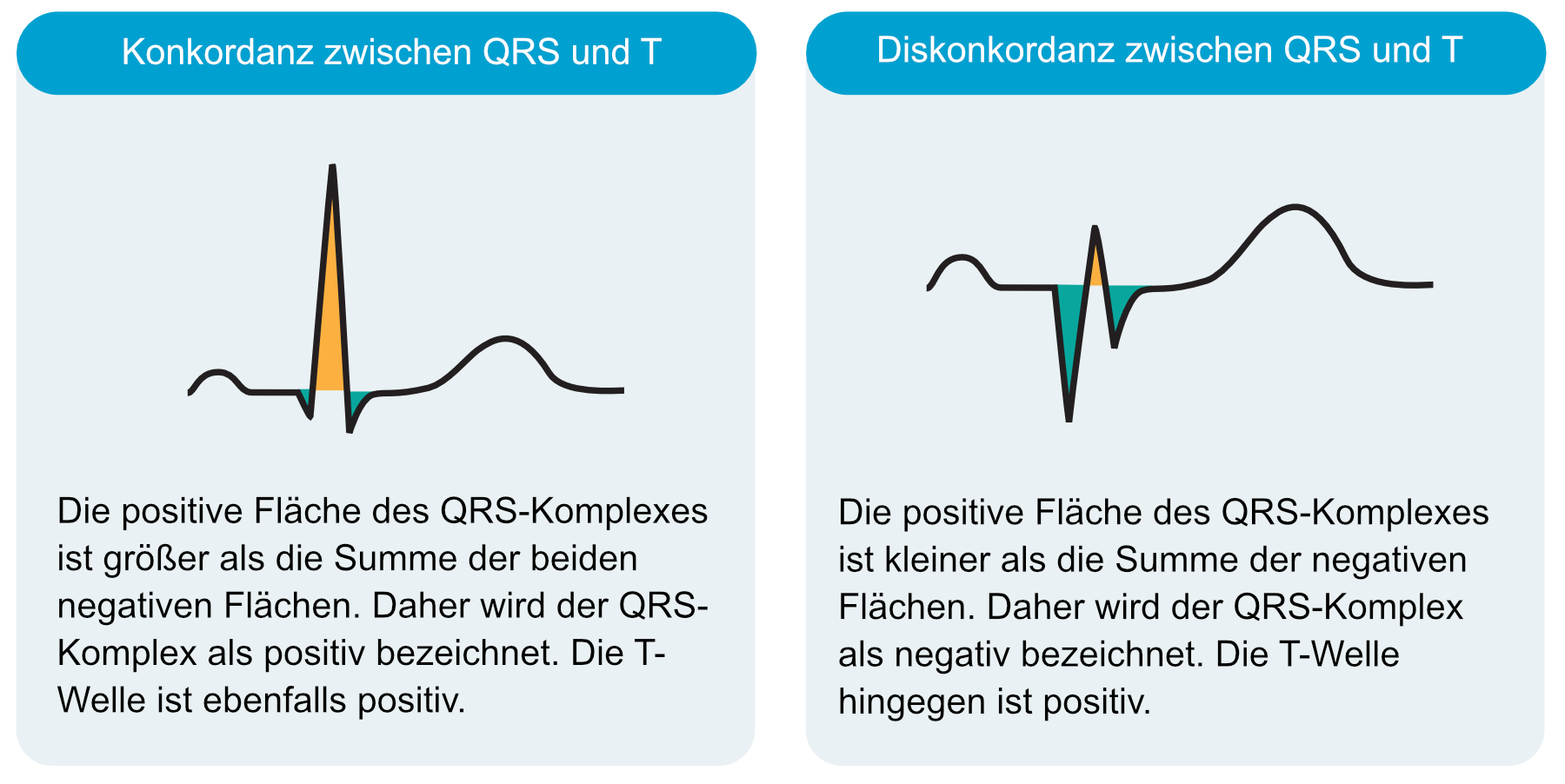 Abbildung 1. Konkordanz und Diskordanz zwischen QRS-Komplex und ST-T-Strecke.