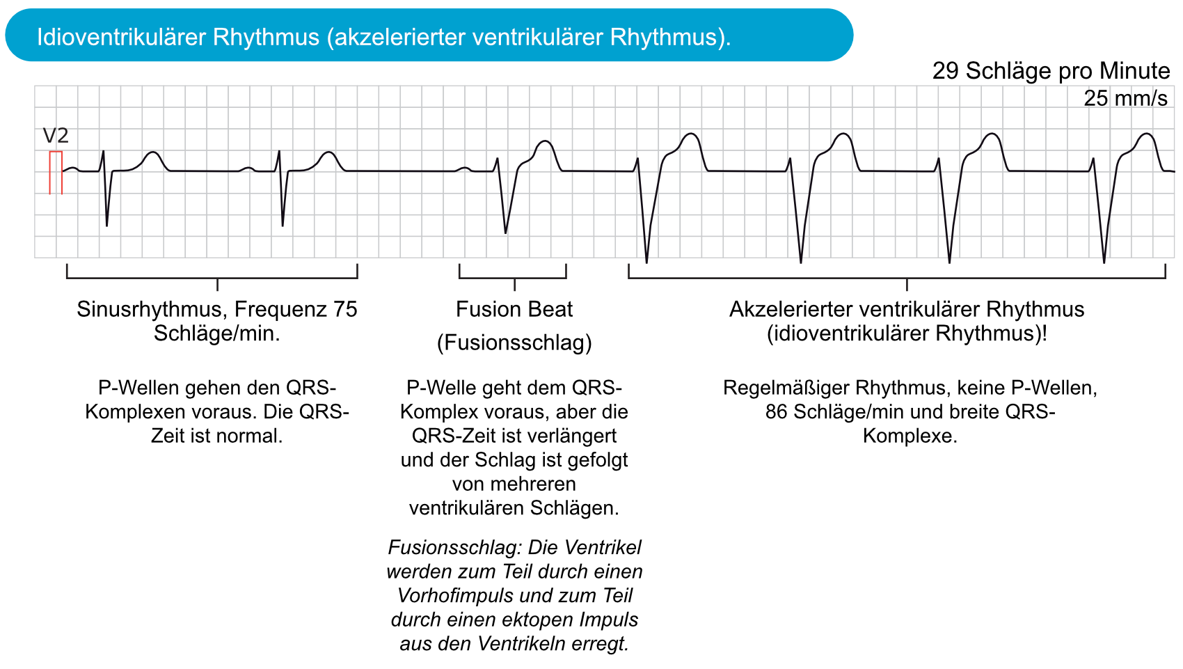 Abbildung 2. Idioventrikulärer Rhythmus (akzelerierter ventrikulärer Rhythmus).