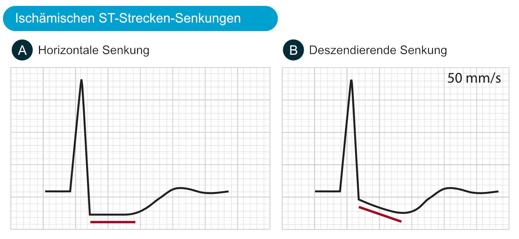 Abbildung 1. Merkmale von ischämischen ST-Strecken-Senkungen im EKG.