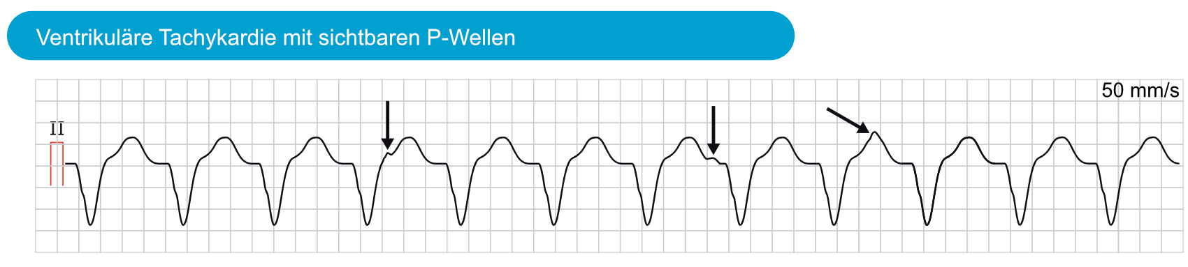Abbildung 1 (wiederholt). Monomorphe ventrikuläre Tachykardie (VT). P-Wellen sind sichtbar, haben aber keinen Bezug zu den QRS-Komplexen. Diese Situation wird als „AV-Dissoziation“ bezeichnet und weist darauf hin, dass die atriale und ventrikuläre Aktivität unabhängig voneinander stattfindet. Die AV-Dissoziation bestätigt, dass die Arrhythmie eine ventrikuläre Tachykardie ist. Eine AV-Dissoziation ist jedoch häufig schwer zu erkennen.