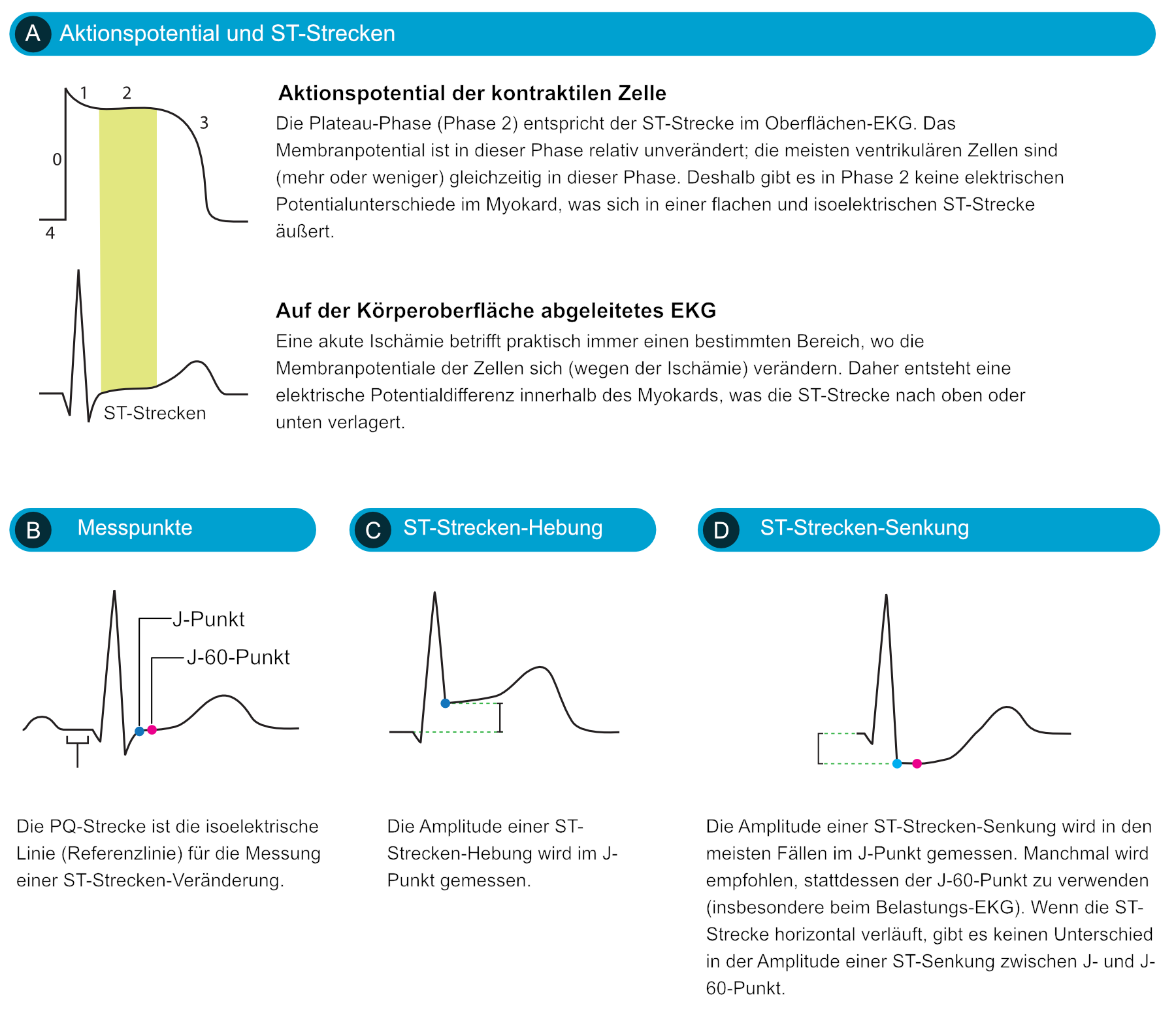 Abbildung 1. (A) Die Beziehung zwischen dem Aktionspotential und der EKG-Kurve. Eine Myokardischämie beeinflusst hauptsächlich die Repolarisation, was sich im EKG in ST-T-Veränderungen widerspiegelt. (B) Beachten Sie, dass das Referenzniveau für die Messung der ST-Strecken-Veränderung (Hebung oder Senkung) durch die PQ-Strecke bestimmt wird. (C) und (D) zeigt, wie der Wert der ST-Strecken-Hebung und ST-Strecken-Senkung bestimmt wird. Der Punkt J-60 liegt 60 ms nach dem J-Punkt.