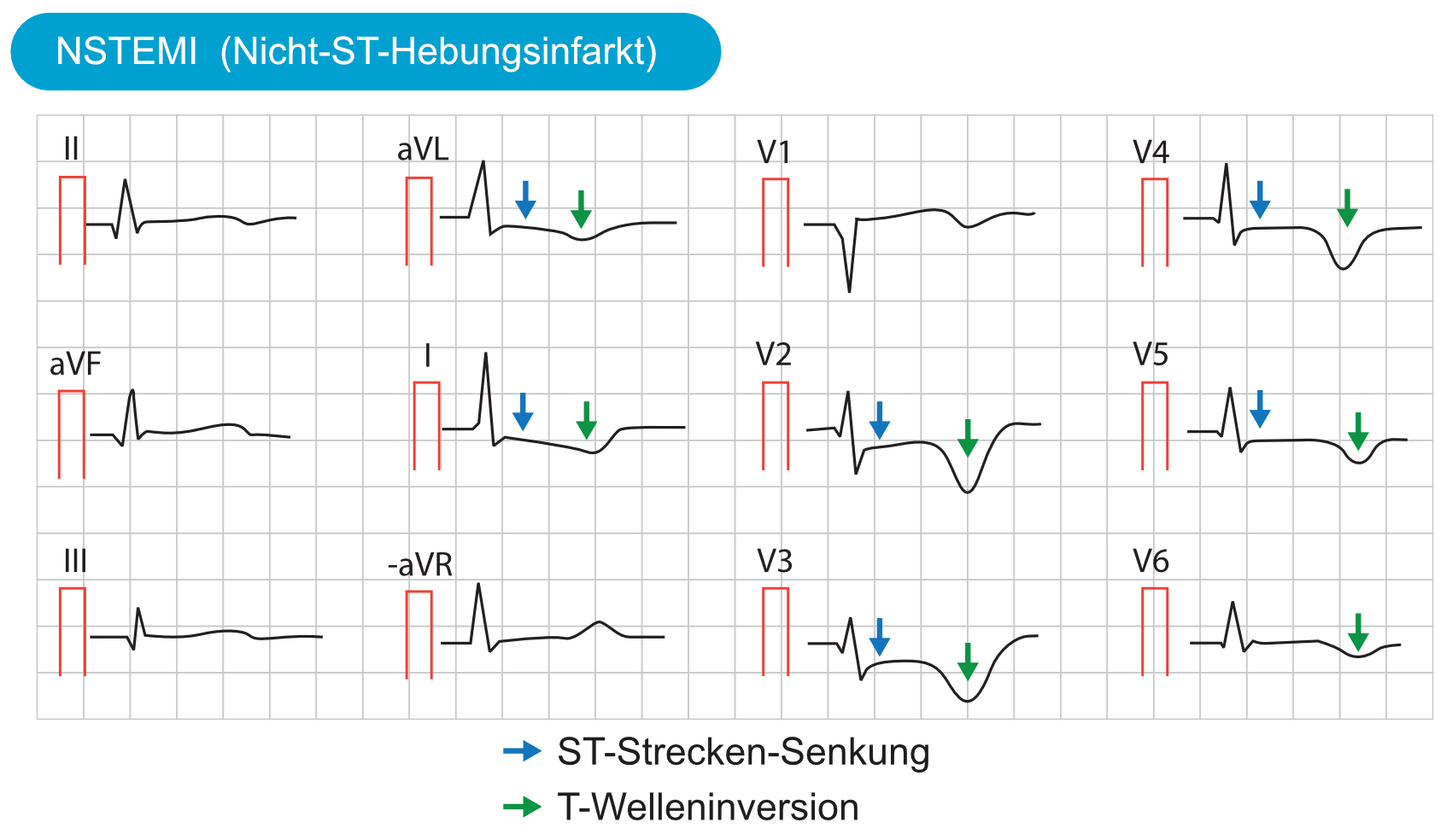 Abbildung 5. Beispiel eines Patienten mit NSTEMI. Dieser Patient zeigt weit verbreitete ST-Senkungen und tiefe T-Welleninversionen in den Brustwandableitungen sowie in aVL und I.
