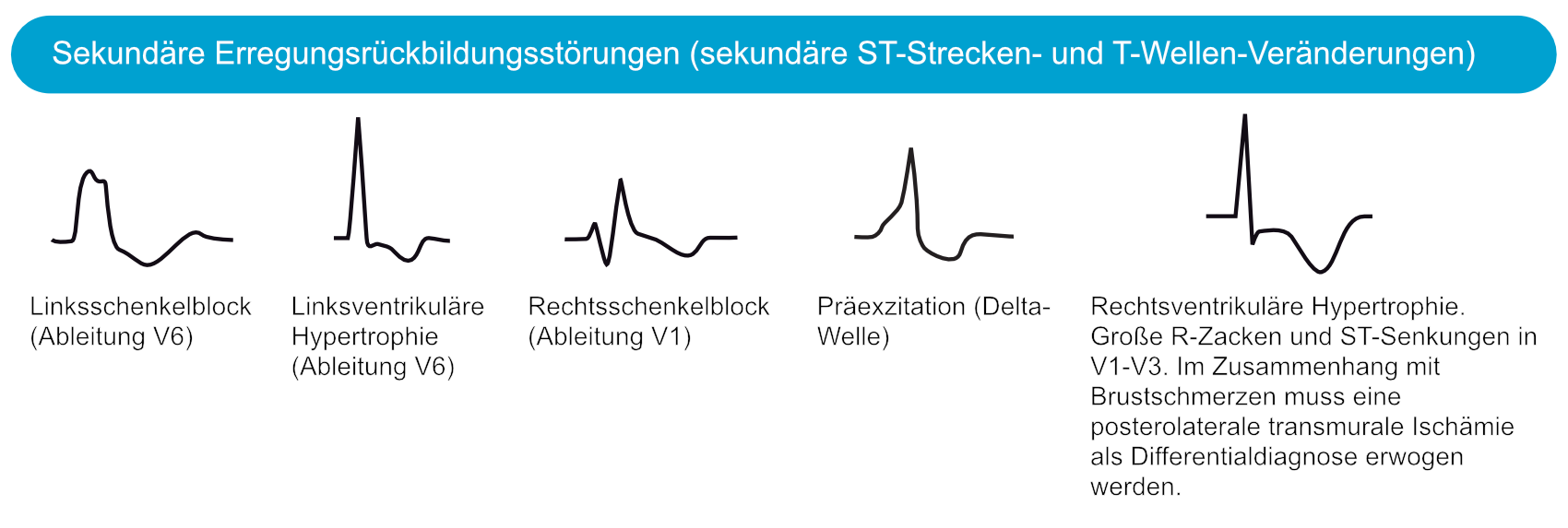 Abbildung 4. Sekundäre ST-T-Änderungen aufgrund von LSB (Linksschenkelblock), LVH (linksventrikuläre Hypertrophie), RSB (Rechtsschenkelblock), Präexzitation (WPW-Syndrom) und RVH (rechtsventrikuläre Hypertrophie).