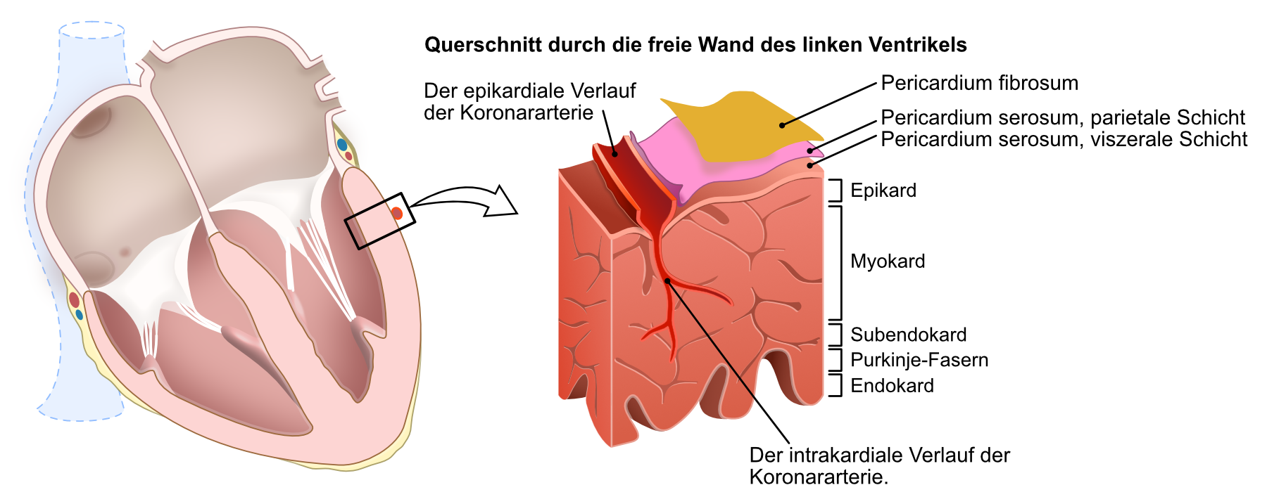 Abbildung 3. Ein STE-ACS (STEMI) wird durch eine vollständige Okklusion verursacht, was bedeutet, dass es keinen Blutfluss mehr in der Arterie gibt. Die Ischämie betrifft alle Schichten des Myokards, vom Endokard bis zum Epikard (in der Region des Herzens, die normalerweise von der verschlossenen Arterie versorgt wird). Diese Art von Ischämie, die alle Myokardschichten betrifft, wird als transmurale Ischämie bezeichnet.