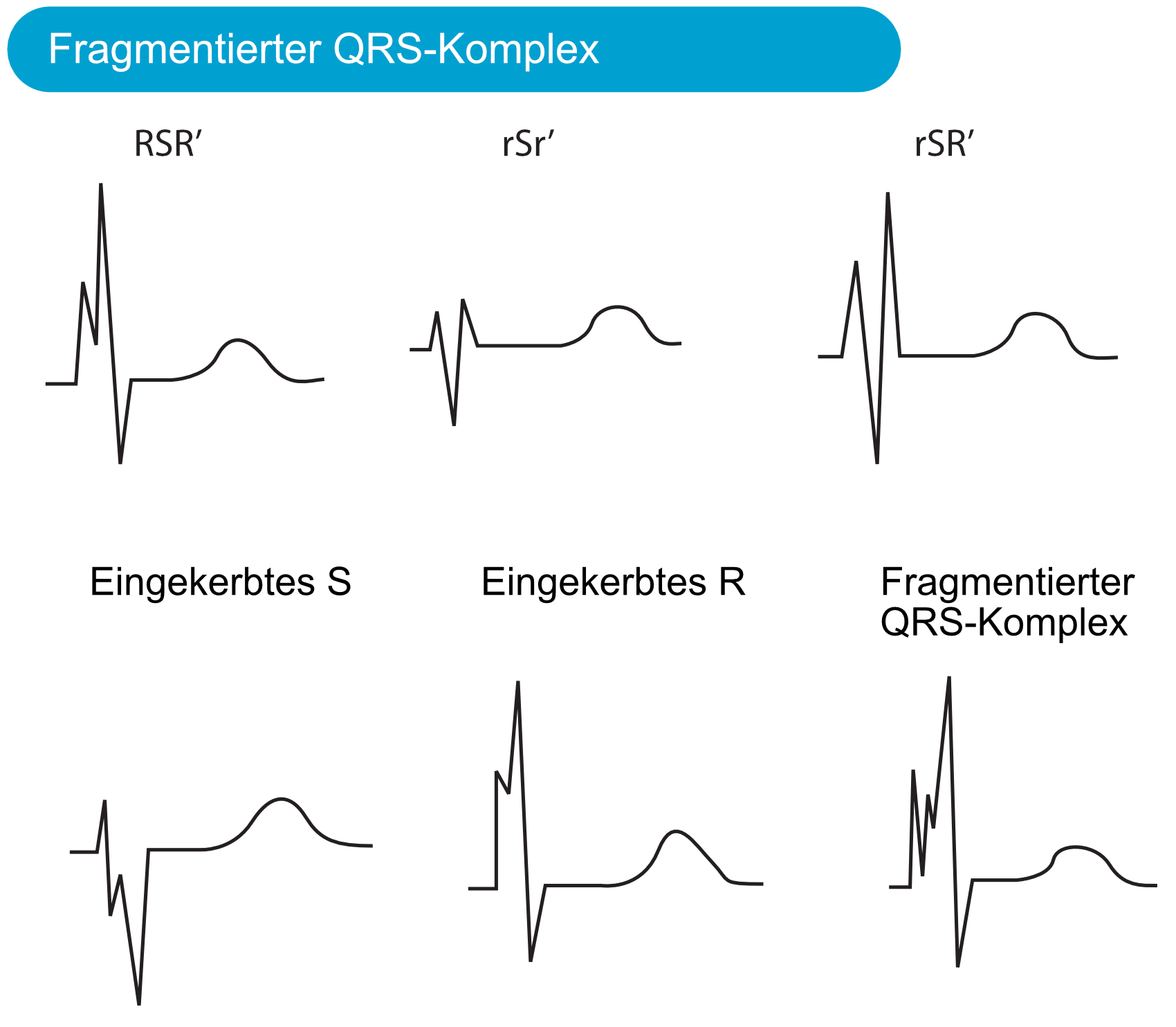 Abbildung 2. Fragmentierter QRS-Komplex. Diese QRS-Konfigurationen sind auch Anzeichen eines früheren Myokardinfarkts.