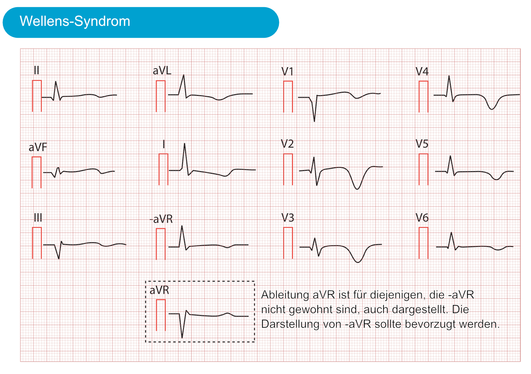 Abbildung 3. Charakteristische T-Wellen-Inversionen, verursacht durch das Wellens-Syndrom. Dieser EKG-Befund wird allgemein als Wellens-Zeichen bezeichnet.