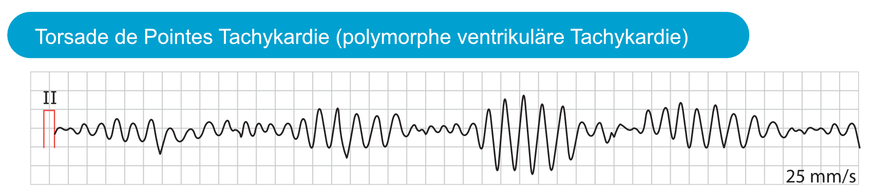 Abbildung 2. Torsade-de-Pointes-Tachykardie (polymorphe ventrikuläre Tachykardie), verursacht durch Long-QT-Syndrom.