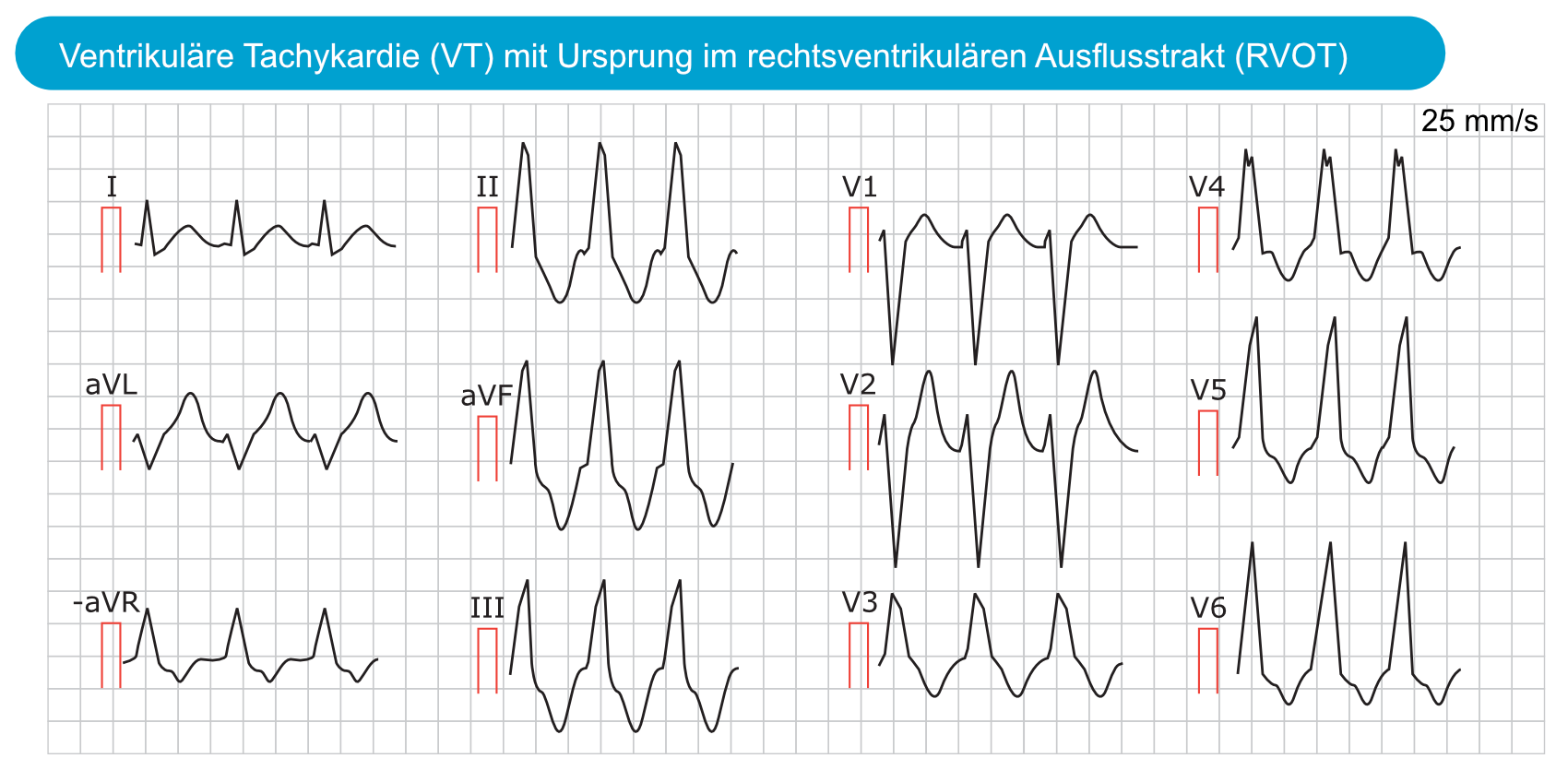 Abbildung 2. Ventrikuläre Tachykardie (VT) mit Ursprung im rechtsventrikulären Ausflusstrakt (RVOT).