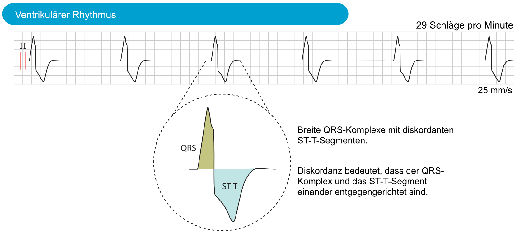 Abbildung 1. Ventrikulärer Rhythmus.