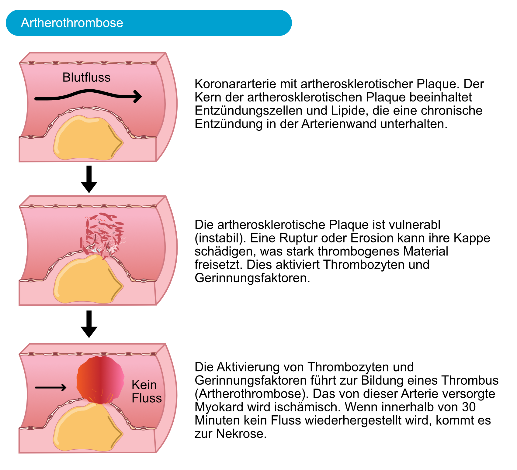 Abbildung 1. Ein akuter Myokardinfarkt wird normalerweise durch eine Ruptur oder Erosion einer vulnerablen (instabilen) atherosklerotischen Koronarplaques ausgelöst.
