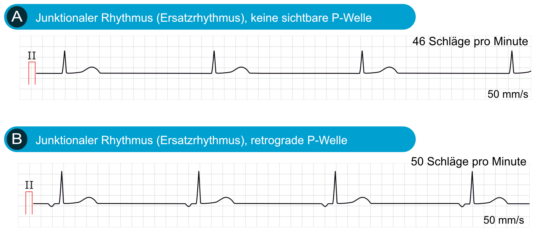 Abbildung 1. Zwei Arten von junktionalen Rhythmen.