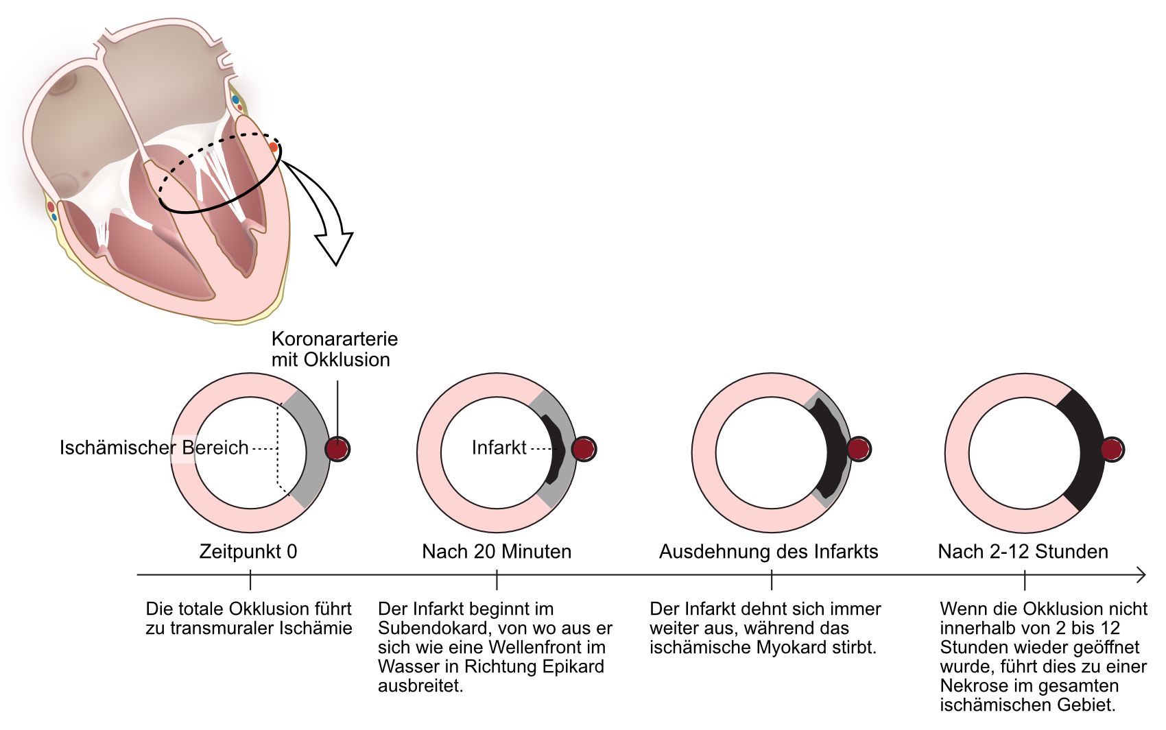 Abbildung 2. Der natürliche Verlauf einer totalen Okklusion (transmurale Ischämie).