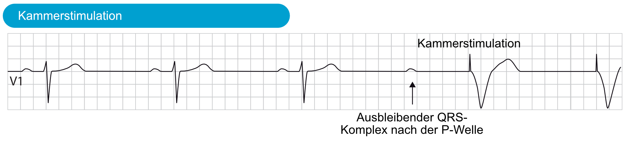 Abbildung 7. AV-Block(blockierte P-Welle), der eine Kammerstimulation auslöst.