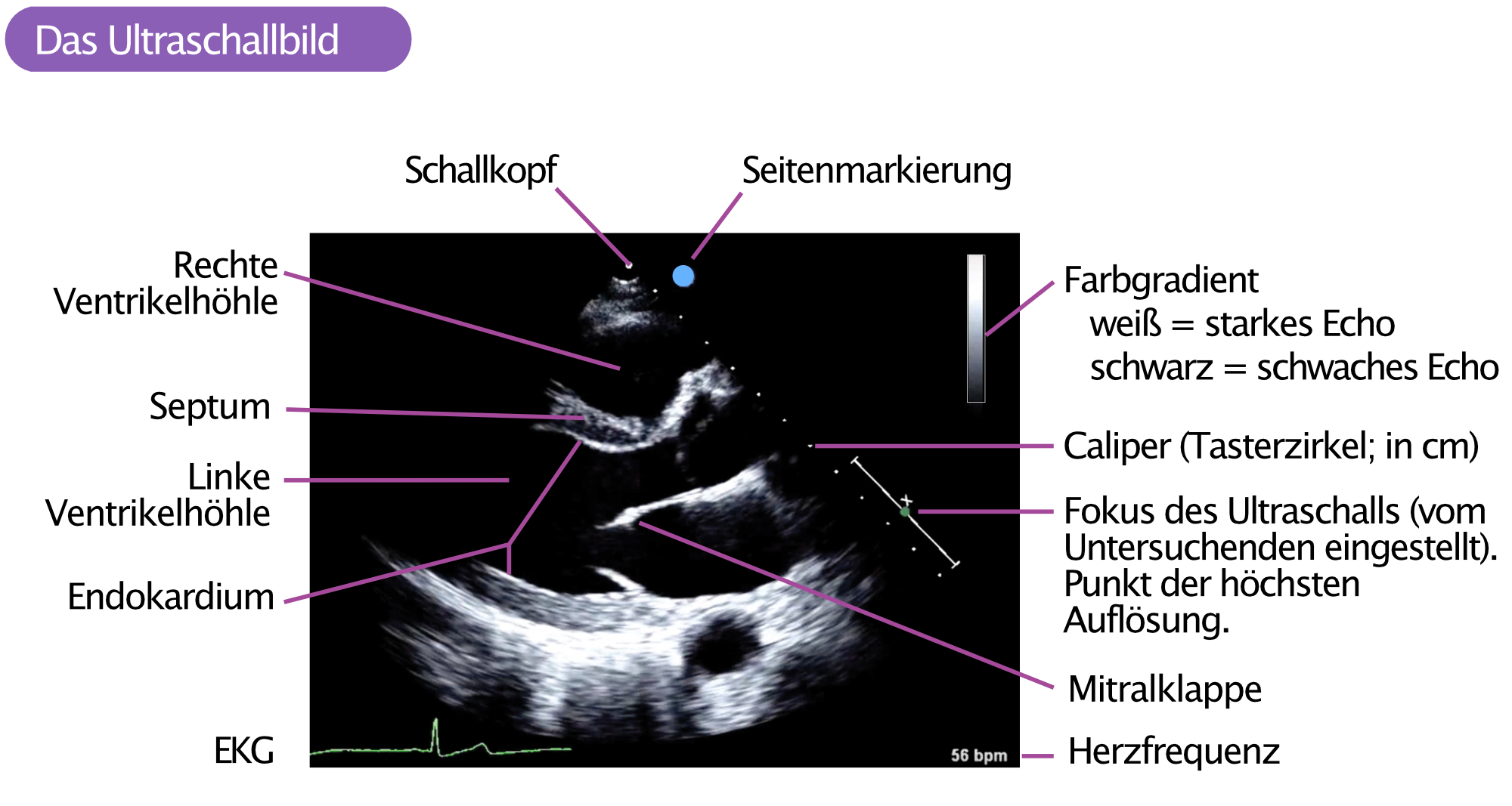 Abbildung 4. Beispiel für ein Ultraschallbild. Diese Ansicht wird als parasternale lange Achse bezeichnet.