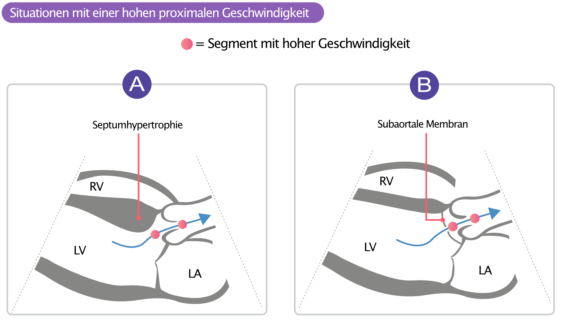 Abbildung 2. (A) Septumhypertrophie und (B) subaortale Membran. LVOT ist in (A) und (B) eingeengt.