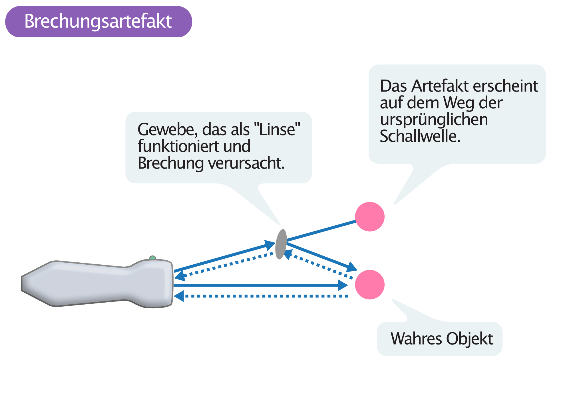 Abbildung 6. Brechungsartefakt.