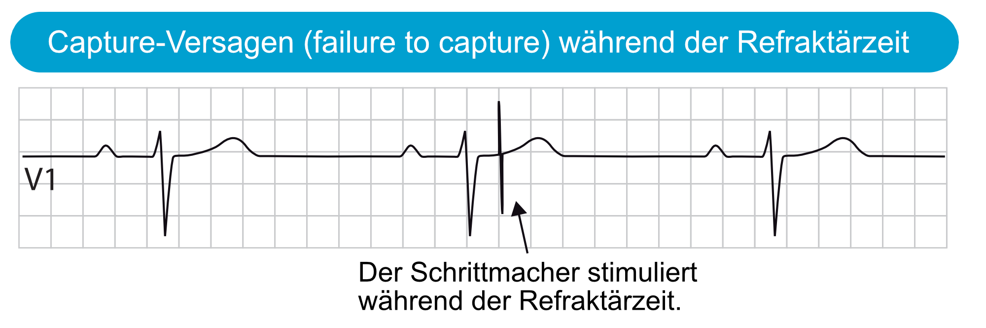 Abbildung 5. Capture-Versagen (failure to capture) während der Refraktärzeit.