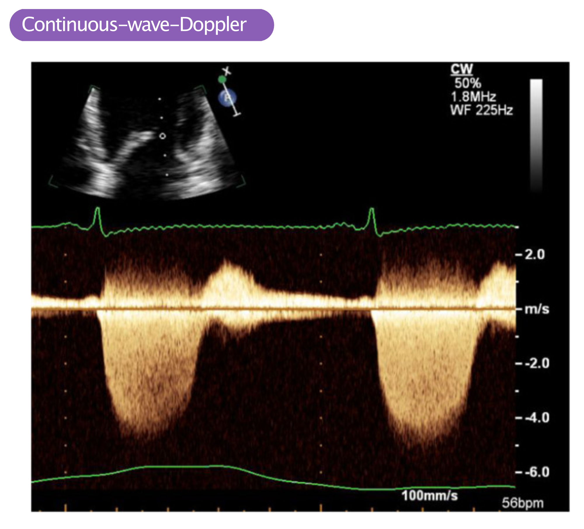 Abbildung 2. Continuous-wave-Doppler (cw-Doppler) entlang des linken Ventrikels, der Mitralklappenöffnung und des linken Vorhofs. Die vom Ultraschallkopf weggerichteten Flussgeschwindigkeiten werden unterhalb der Grundlinie angezeigt und die Geschwindigkeiten in Richtung Schallkopf werden über der Grundlinie angezeigt. Dieses Bild zeigt einen schnellen und deutlichen Fluss (fast 5 m/s), der während der Systole vom Ultraschallkopf weg gerichtet ist (die Systole beginnt auf dem Höhepunkt der R-Welle auf dem EKG). Dieses Doppler-Signal stellt eine ausgeprägte Mitralinsuffizienz dar.