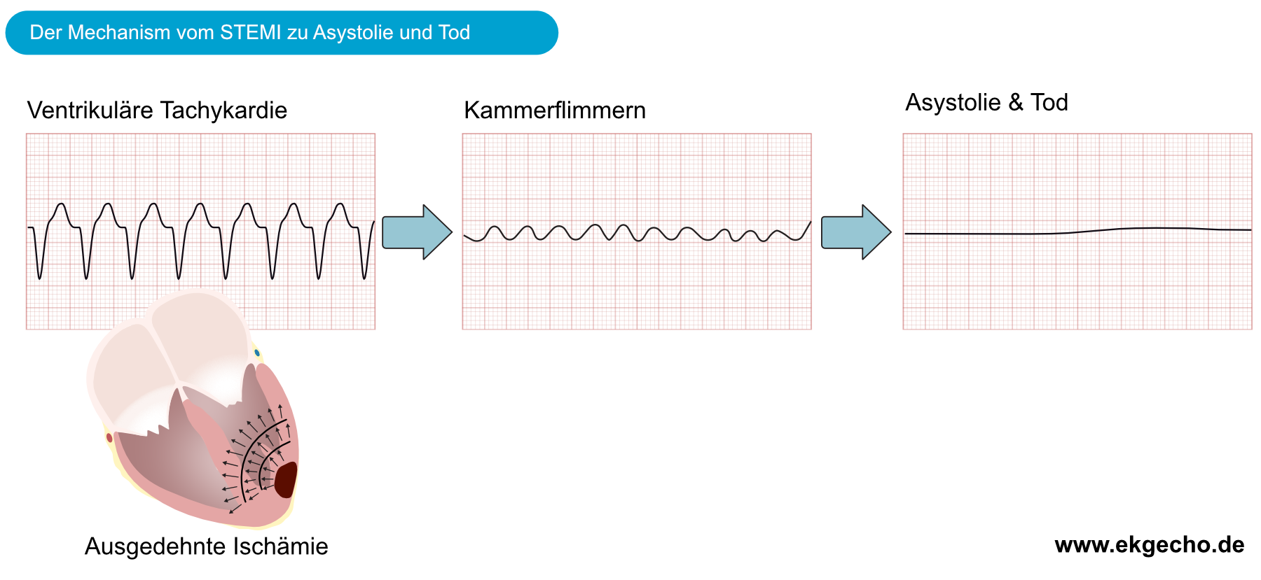 Abbildung 8. Das Fortschreiten eines ST-Hebungsinfarktes (STEMI) zu Asystole und Tod.