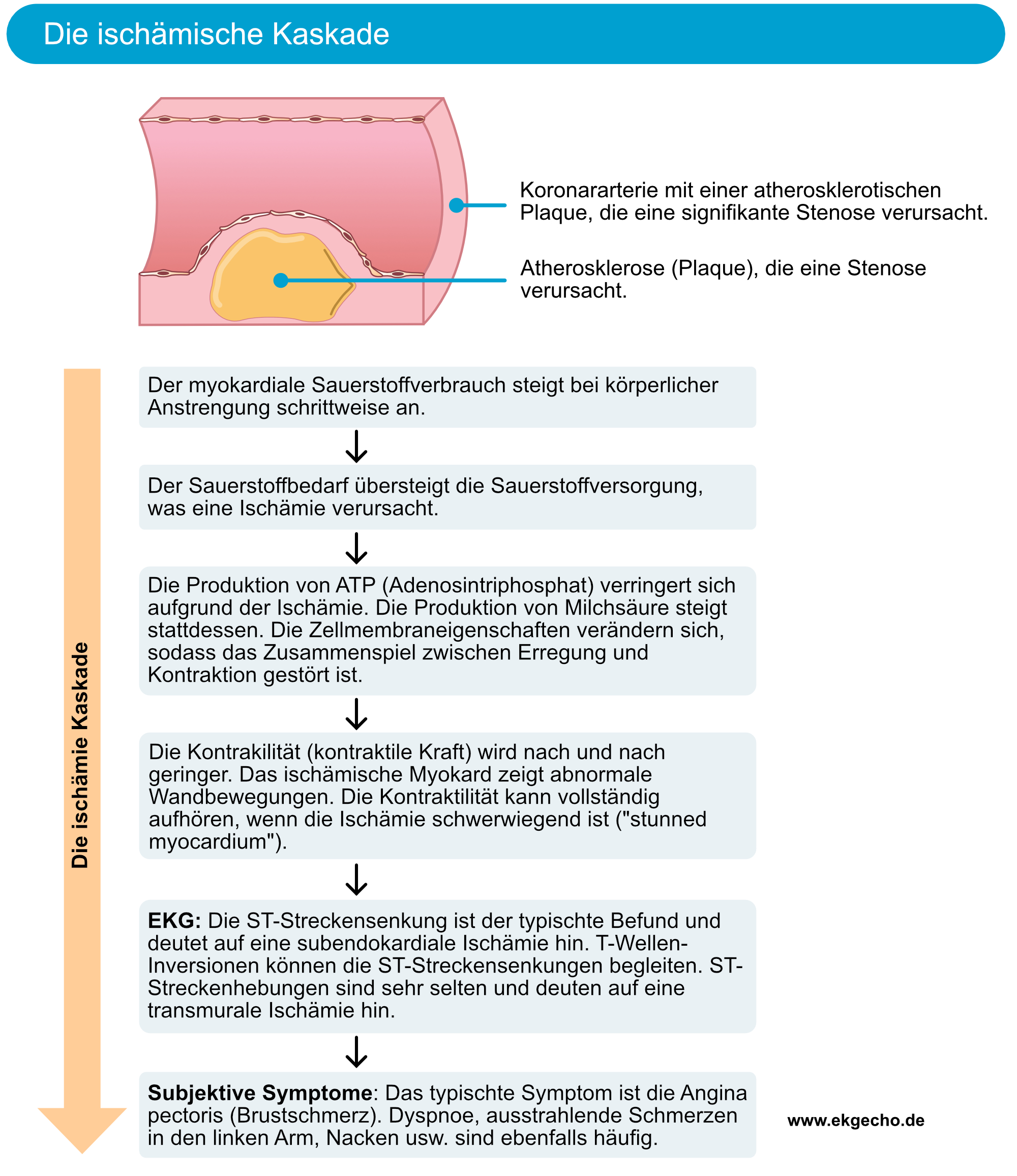 Abbildung 2. Die ischämische Kaskade veranschaulicht den Verlauf von Ischämie zu EKG-Veränderungen und klinischen Symptomen. Wie gezeigt, sind klinische Symptome (z.B. Brustschmerzen) die letzten Ereignisse während einer ischämischen Episode. Daraus folgt, dass eine Myokardischämie auch ohne klinische Symptome auftreten kann. Das EKG erkennt außerdem mehr ischämische Episoden als jene, über die Patienten berichten.