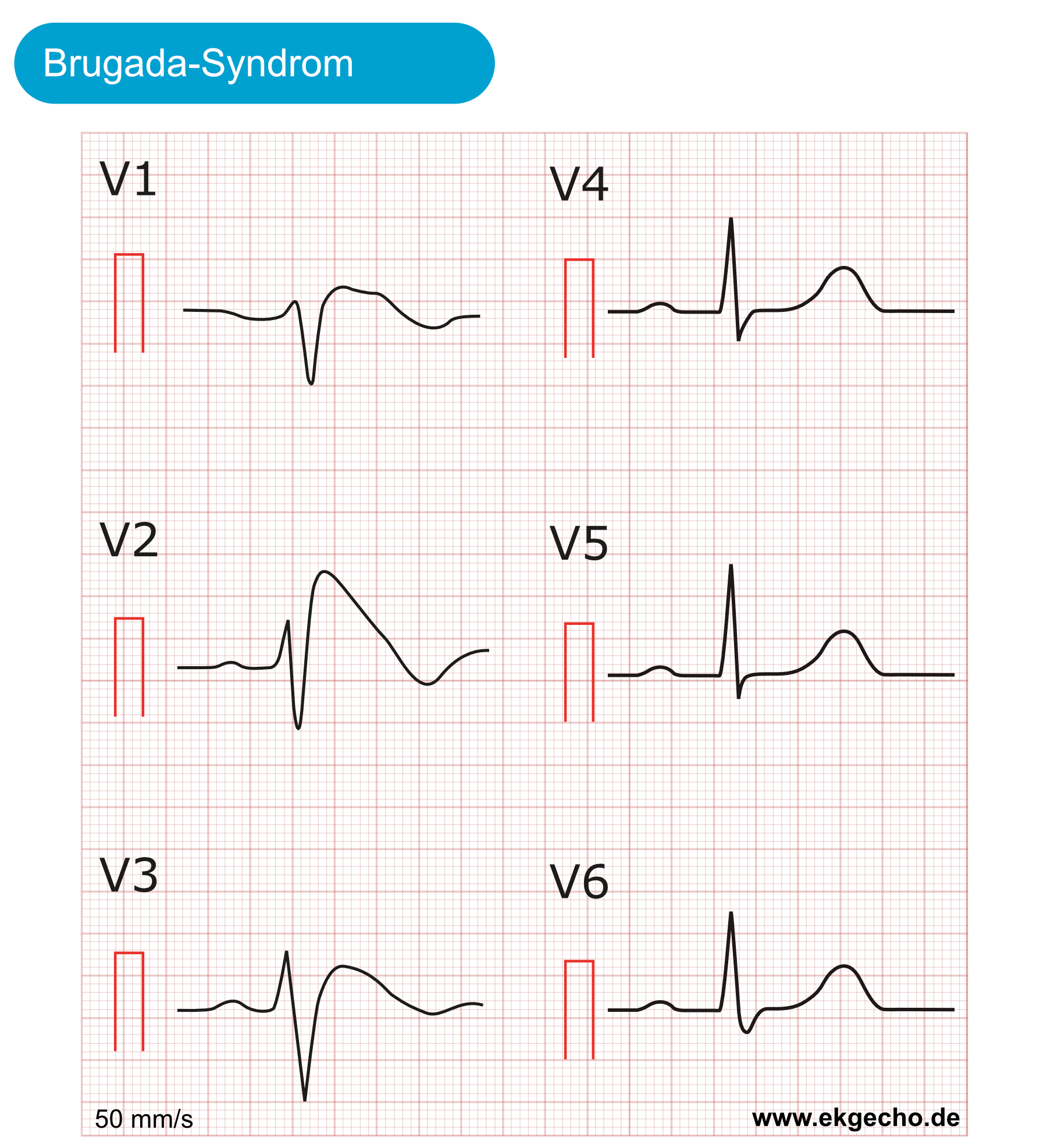 Abbildung 2. Brugada-Syndrom. Beachte die gigantische J-Welle in V2 und V3. Dies kann mit einem Rechtsschenkelblock verwechselt werden. Schreibgeschwindigkeit 50 mm/s.