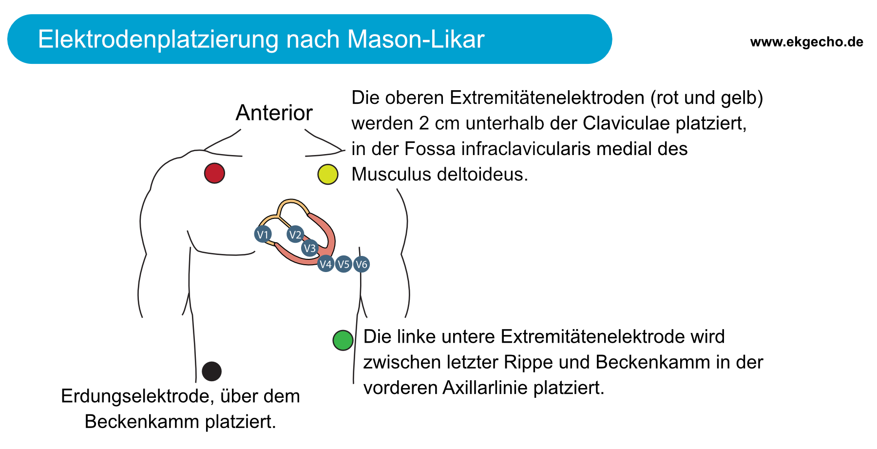 Abbildung 1. Ableitung Platzierung für Übungs-EKG. Beachten Sie, dass die Platzierung von Präkordialleitungen (Brust) nicht geändert wird. Die Extremitätenableitungen werden in den Torso verlagert. Dies reduziert Artefakte (Muskelartefakte) während Belastungstests.
