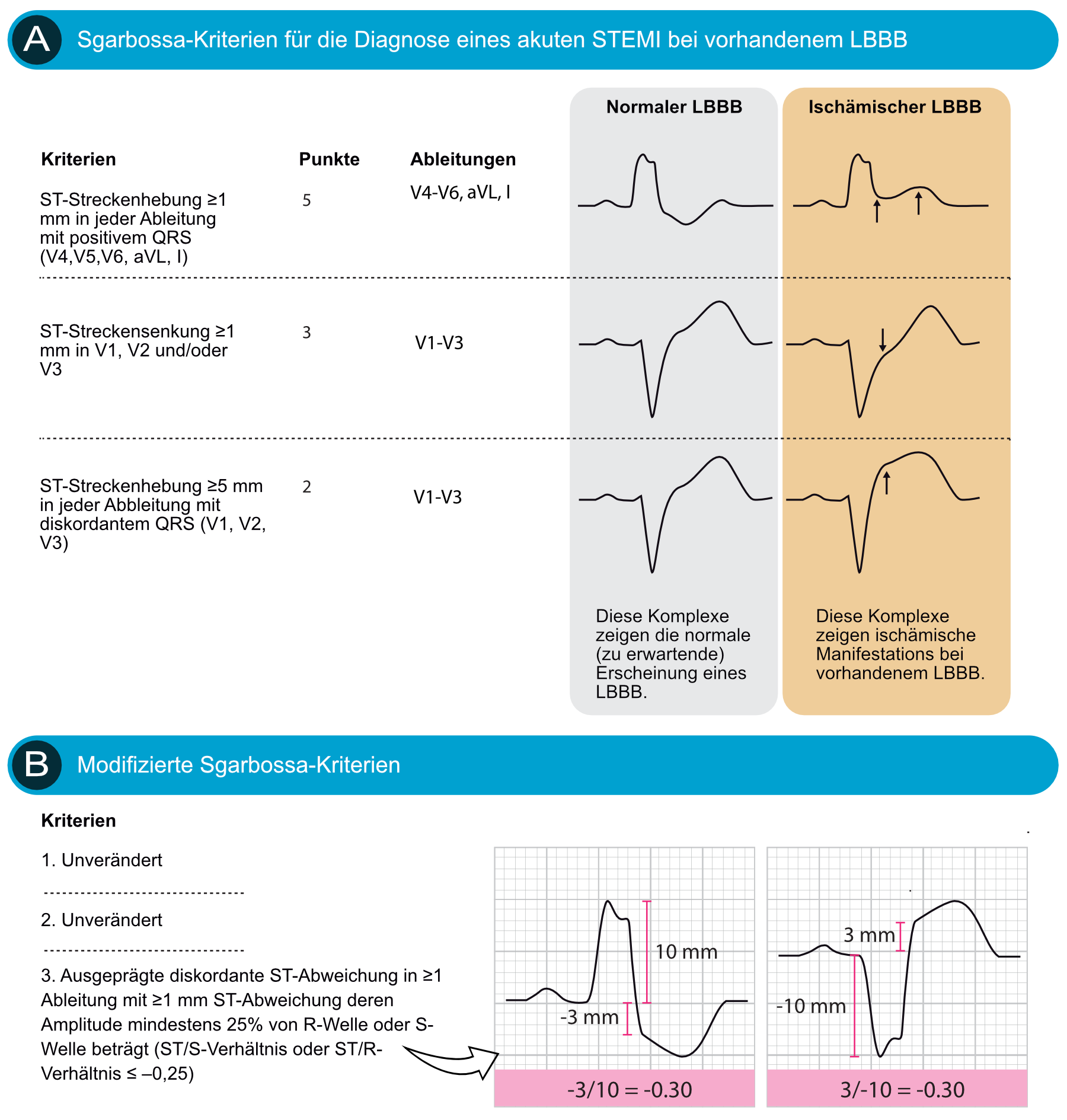 Abbildung 7. EKG-Kriterien (Sgarbossa-Kriterien) für einen STEMI bei vorhandenem Linksschenkelblock. Jedes Kriterium ergibt 2 bis 5 Punkte. Studien zeigen, dass ein Cut-Off von ≥3 Punkten eine Sensitivität von 20— 36% und eine Spezifität von 90— 98% für einen STEMI bei Linksschenkelblock ergibt.