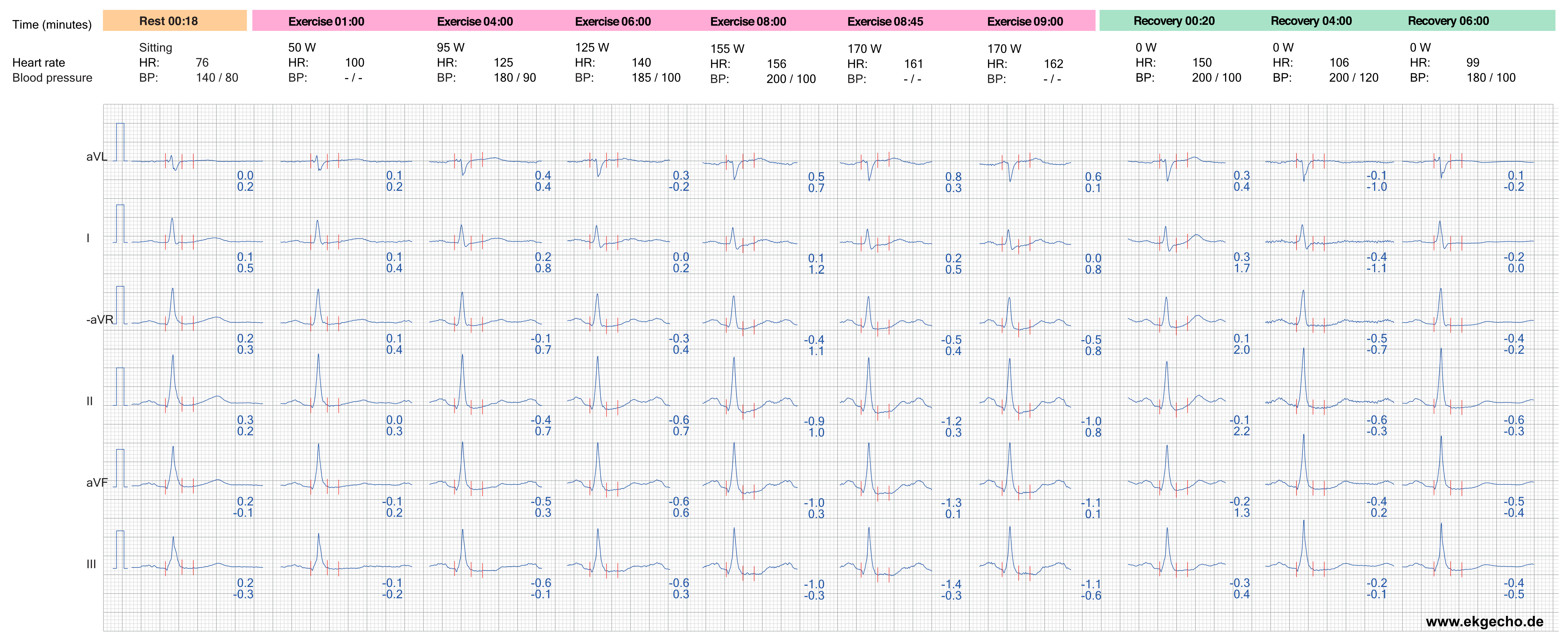 Abbildung 8. Die EKG-Reaktion in den Brustwandableitungen während der Belastung und Erholung.