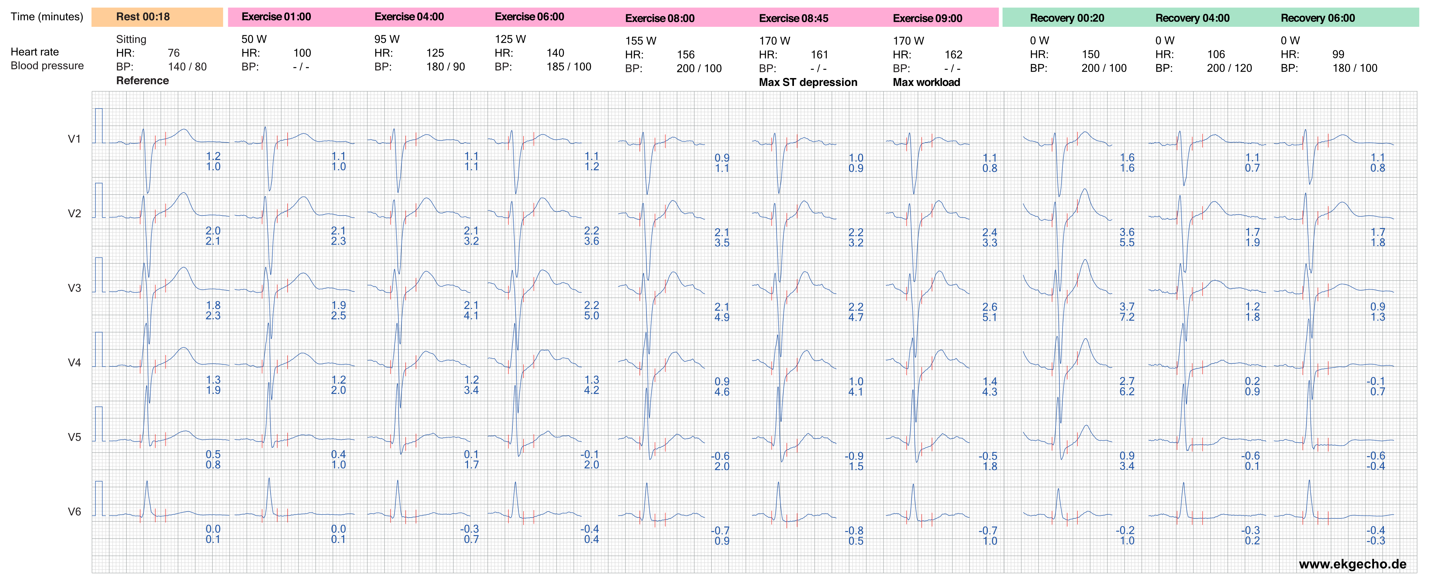 Abbildung 7. Die EKG-Reaktion in den Extremitätenableitungen während der Belastung und Erholung.