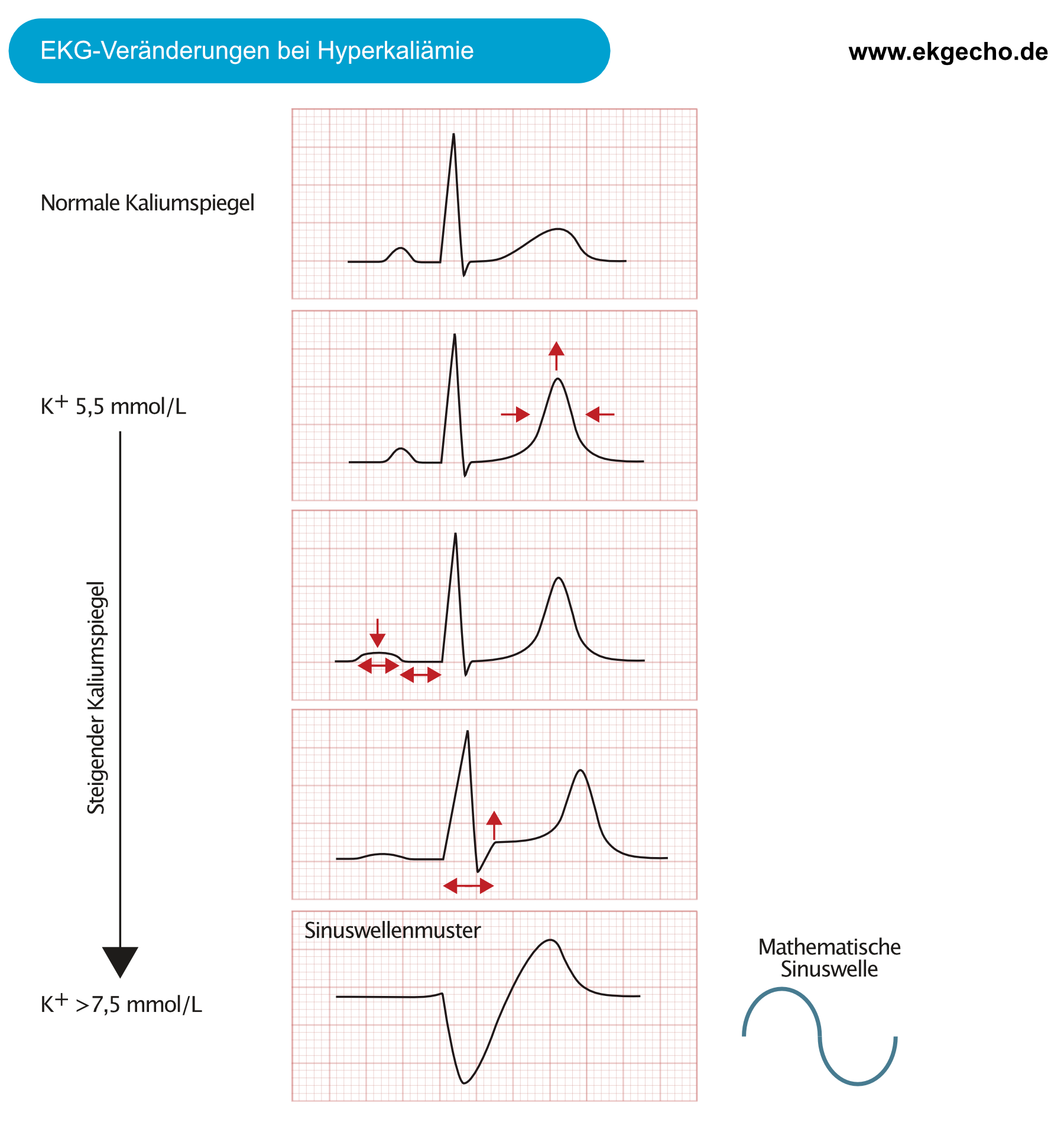 Abbildung 1. EKG-Veränderungen bei Hyperkaliämie.