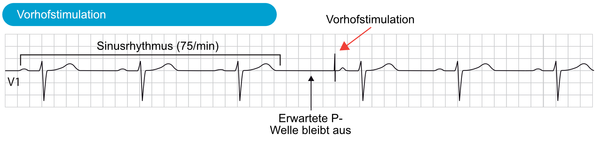 Abbildung 6. Ein fehlender oder verzögerter Sinusimpuls ruft eine Vorhofstimulation hervor.
