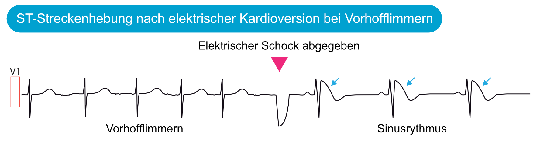 Abbildung 12. Elektrische Kardioversionen führen zu ST-Streckenhebungen.