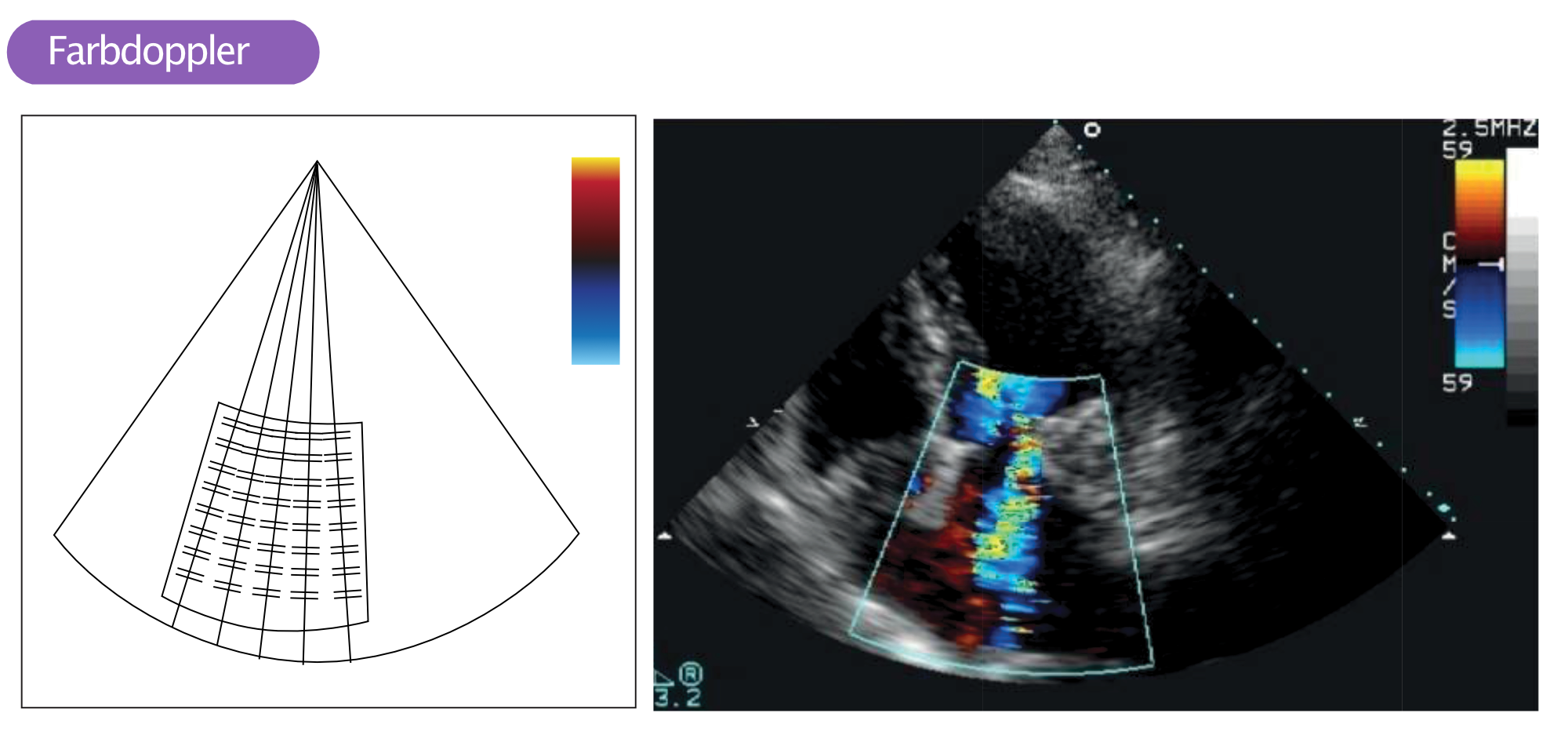 Abbildung 1. Das Bild links zeigt viele Sample Volumes innerhalb eines Doppler-Sektors. Das Bild rechts zeigt den Farbdoppler, der sich über der Mitralklappe und dem linken Vorhof befindet.