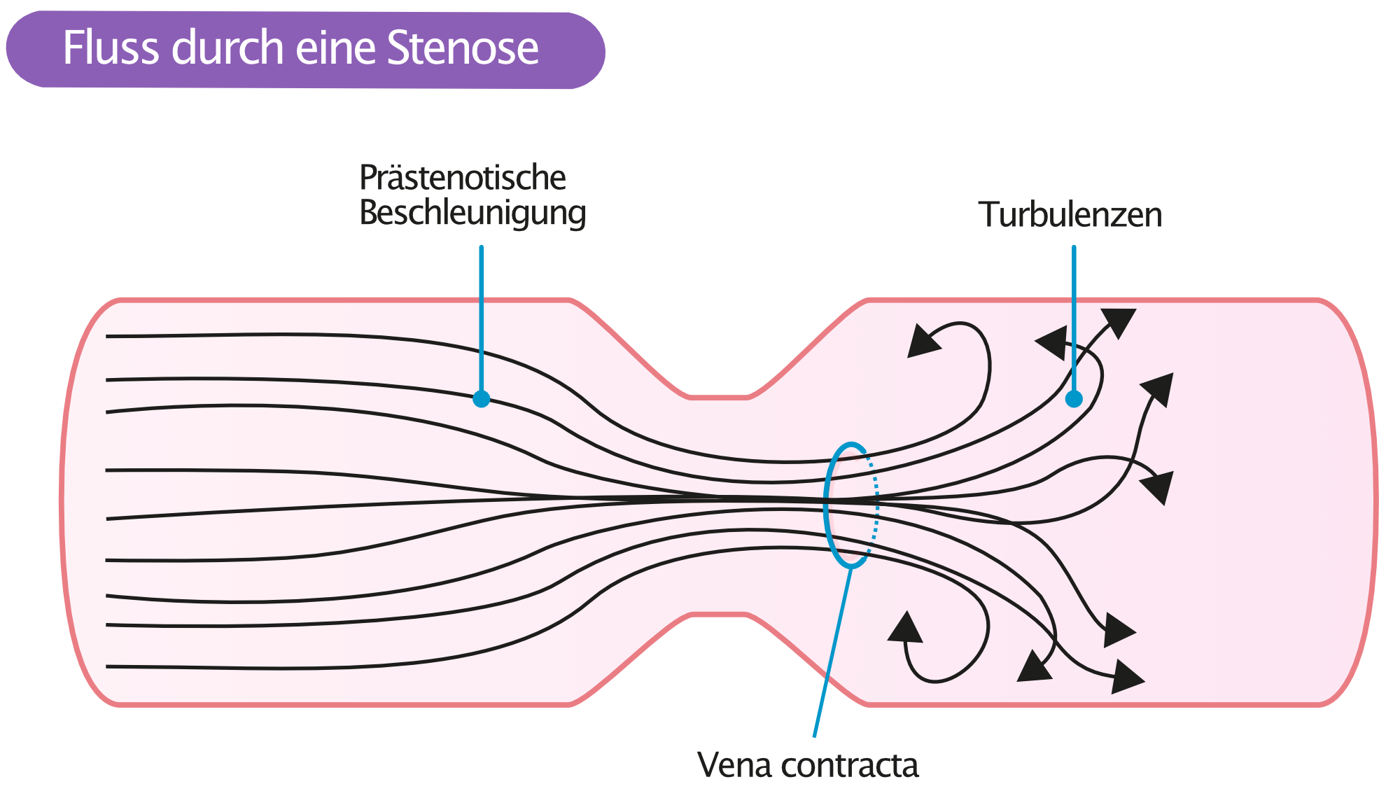 Abbildung 3. Poststenotische Turbulenzen und Lage der Vena contracta.