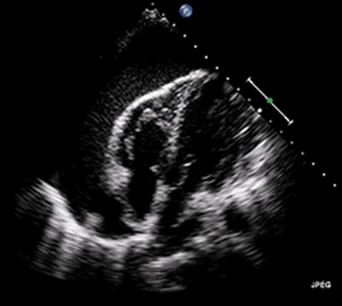 Video 1. Herztamponade. Das Herz ist von Flüssigkeit (schwarz) umgeben und schwingt in der Flüssigkeit hin und her. Man kann auch feststellen, dass die rechtsventrikuläre freie Wand von der Flüssigkeit komprimiert wird. Videoquelle.