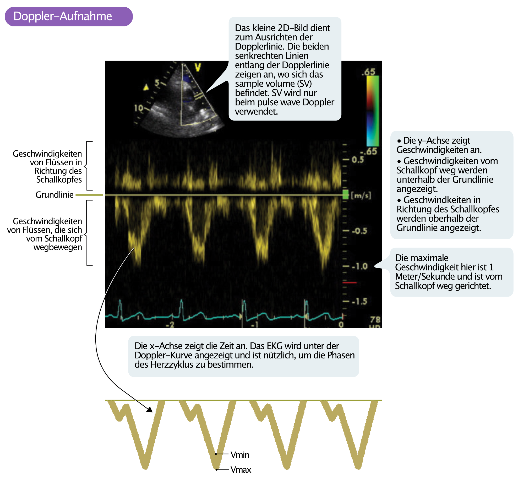 Abbildung 7. Darstellung und Interpretation von Doppler-Signalen.