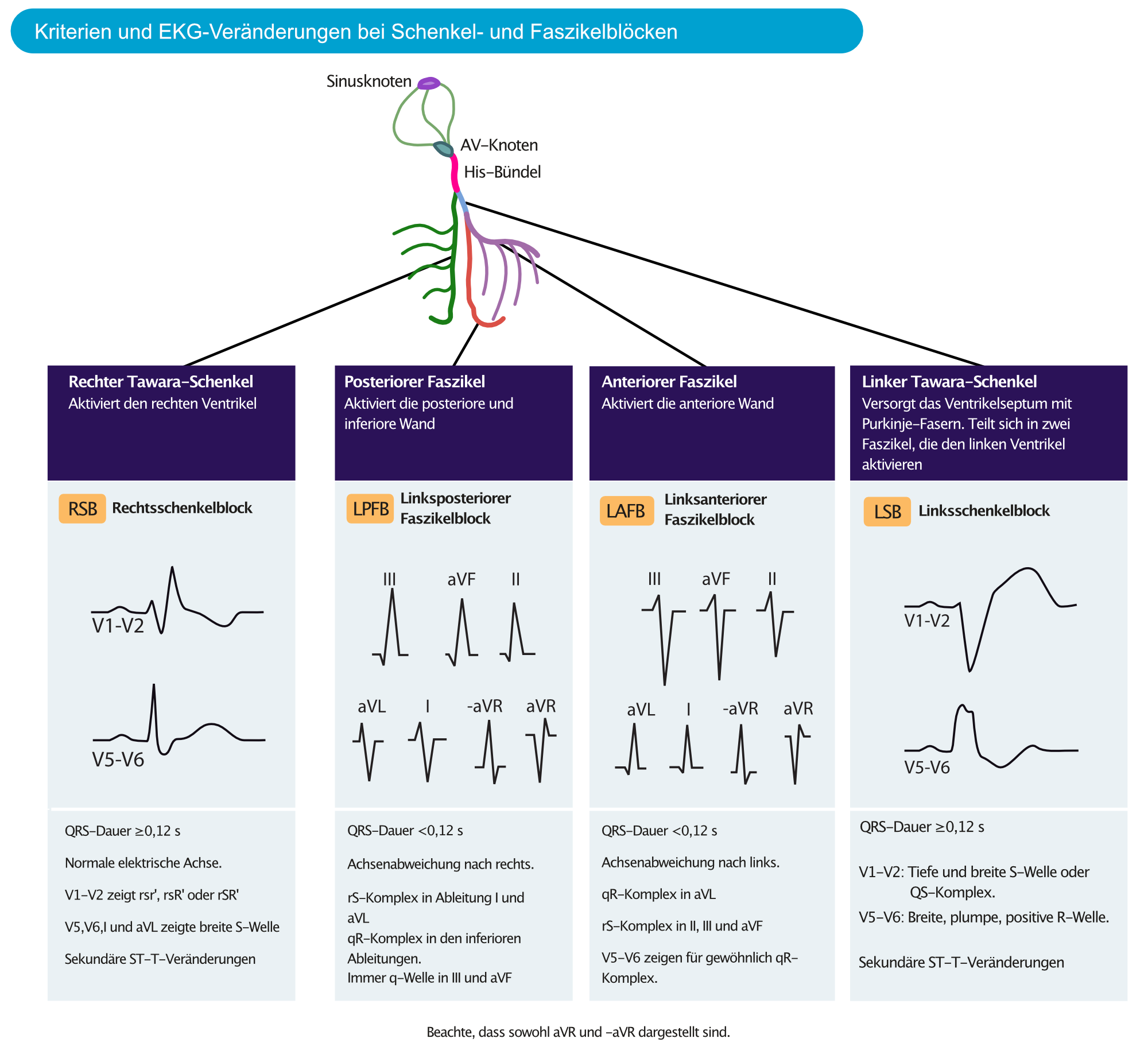 Abbildung 3. Überblick über Kriterien und EKG-Veränderungen bei Schenkel- und Faszikelblöcken. All diese intraventrikulären Reizleitungsstörungen sind häufig und daher wichtig zu erkennen.