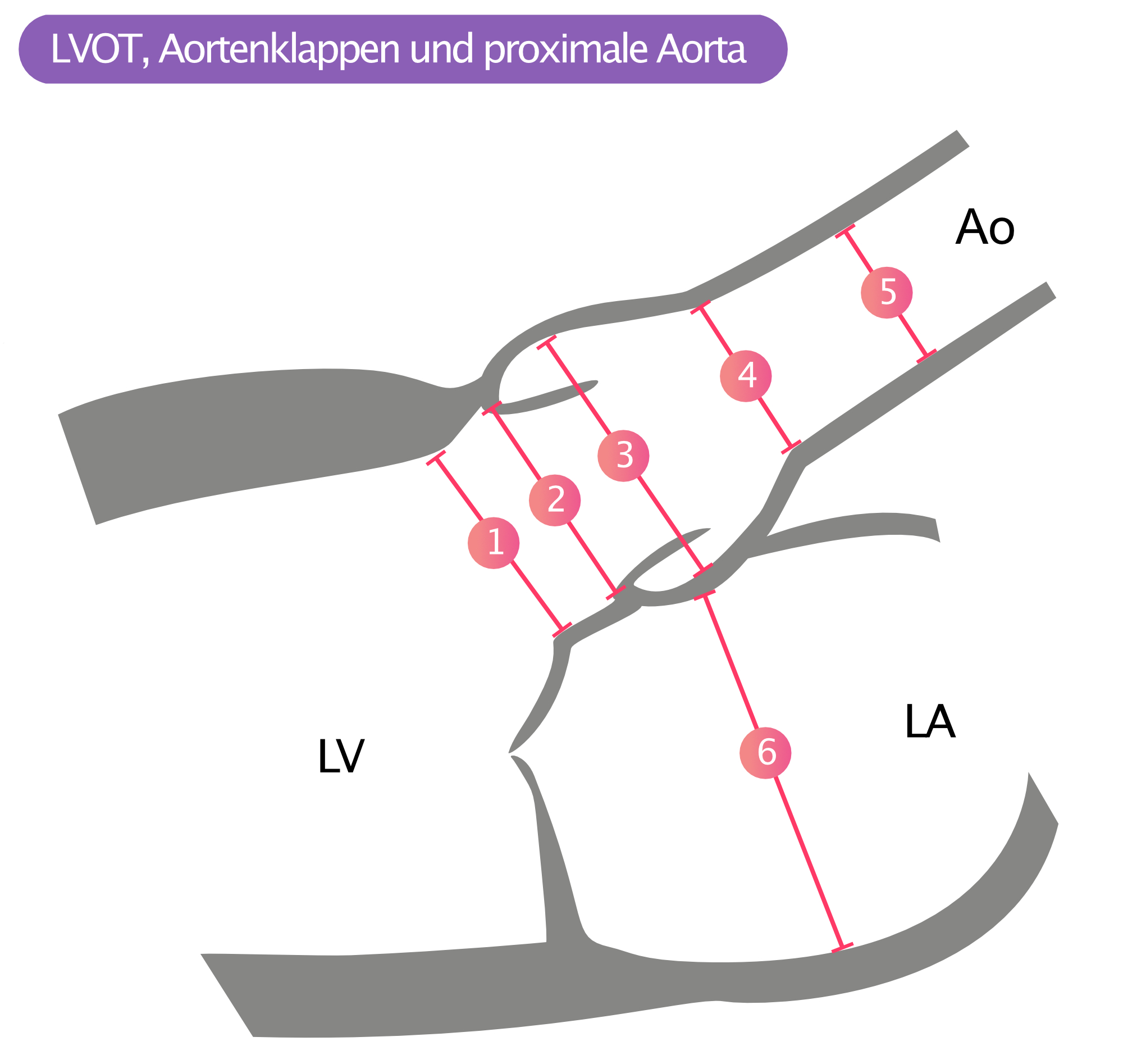 Abbildung 4. LVOT, Aortenklappen und Aorta ascendens. 1 = LVOT Durchmesser; 2 = Aortenannulus; 3 = Sinus aortae; 4 = Sinotubulärer Übergang; 5 = Aorta ascendens; 6 = Vorhof-Dimension.