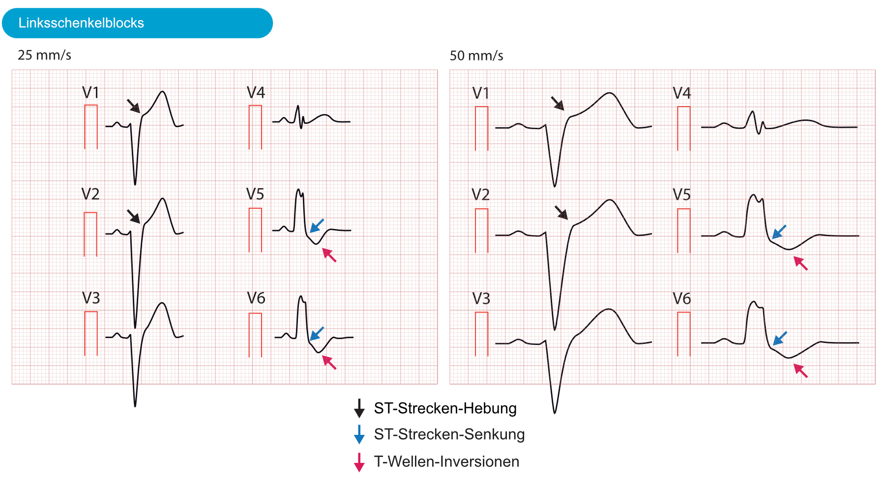 Abbildung 6. Linker Schenkelblock (LBBB) bei zwei verschiedenen Papiergeschwindigkeiten mit ST-Hebungen und ST-Senkungen.