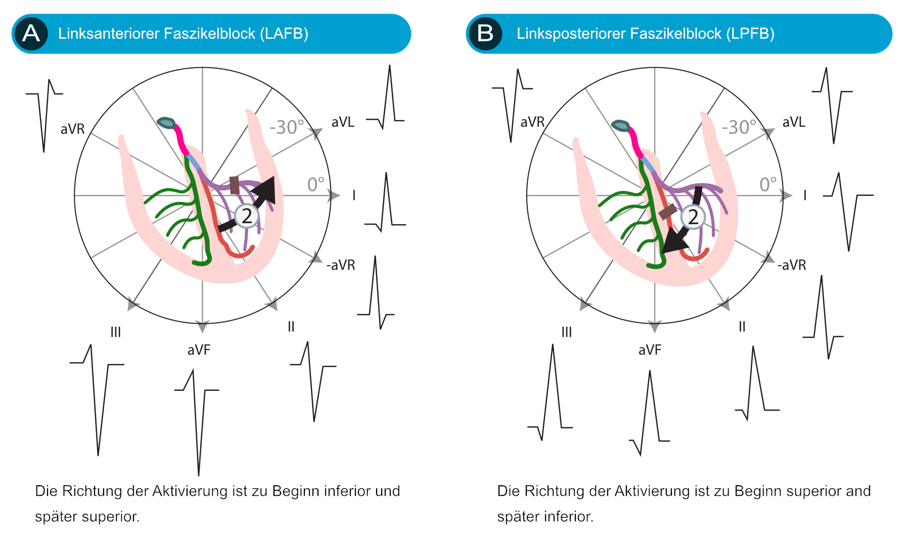Abbildung 1. Linksanteriorer und linksposteriorer Faszikelblock. Inspiriert von GS Wagner (Marriotts Practical Electrocardiography, Elsevier 2007) und AL Goldberg (Clinical Electrocardiography: A Simplified Approach, Elsevier Mosby 2006).