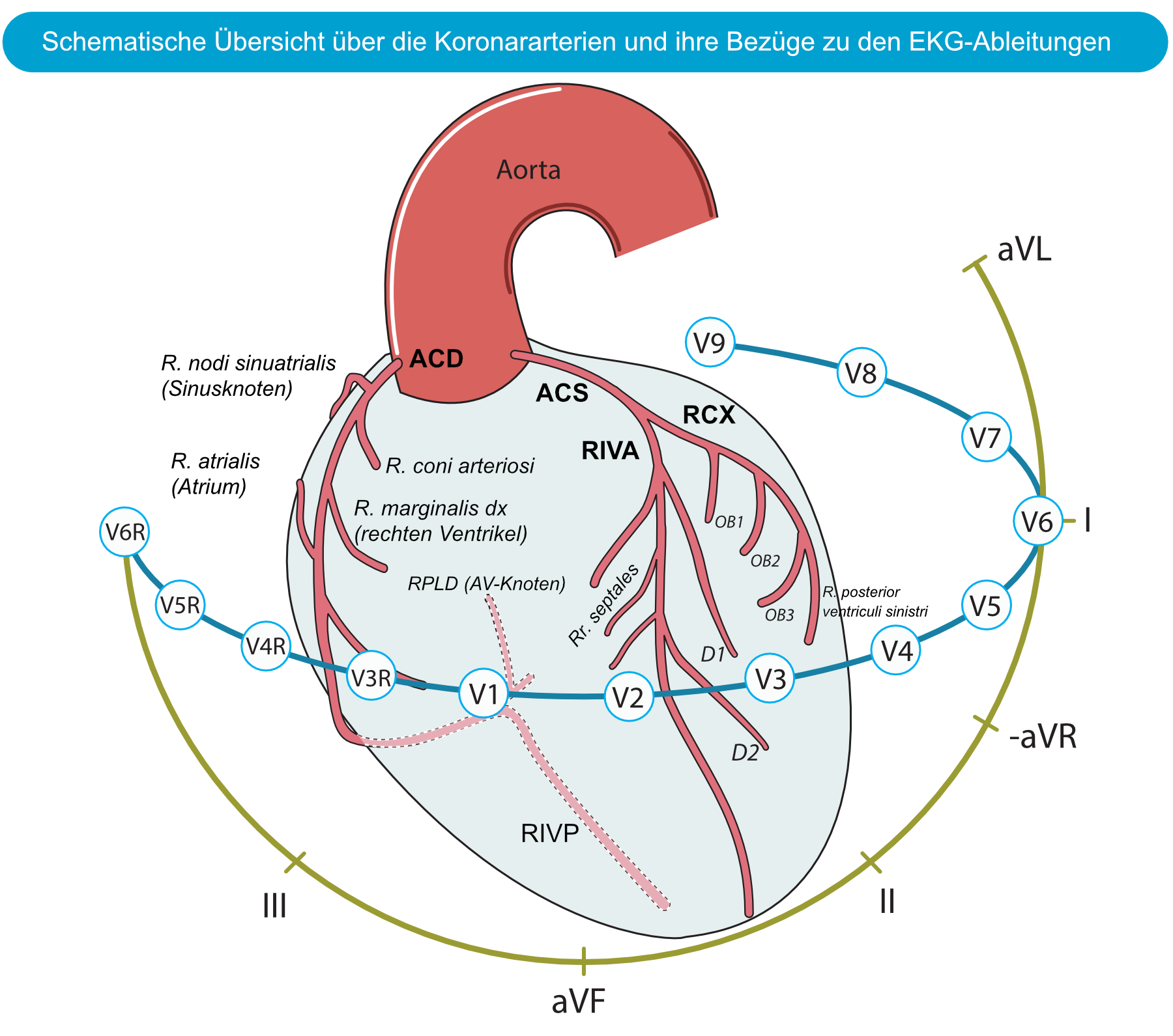 Abbildung 1. Die Koronararterien und ihre Beziehung zu den EKG-Ableitungen. Die Lokalisation des Myokardinfarkts/der Ischämie ist möglich, indem anhand von EKG-Veränderungen der betroffene Bereich bestimmt wird und daraus auf die verschlossene Koronararterie (Culprit) geschlossen werden kann.