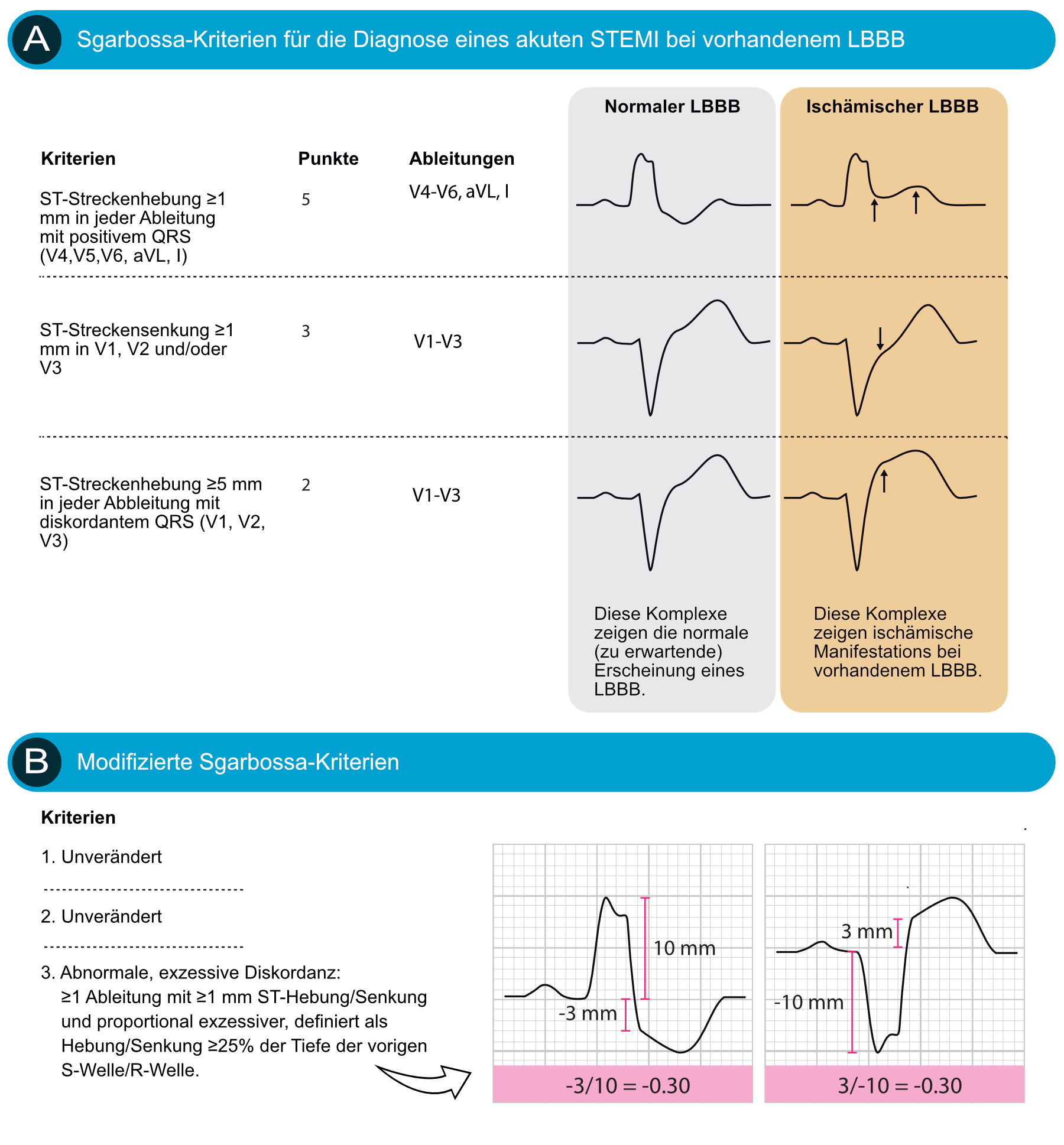 Abbildung 1. (A) EKG-Kriterien (Sgarbossa-Kriterien) für einen akuten ST-Hebungsinfarkt (STEMI) bei der vorhandenem LSB. Jedes Kriterium ergibt 2 bis 5 Punkte. Studien zeigen, dass ein Cut-Off von ≥3 Punkten eine Sensitivität von 20— 36% und eine Spezifität von 90— 98% für einen akuten ST-Hebungsinfarkt (STEMI) bei LSB ergibt. (B) Die Kriterien 1 und 2 der ursprünglichen Sgarbossa-Kriterien bleiben unverändert. Die R- oder S-Welle (je nachdem, welche am auffälligsten ist) und die ST-Strecke (relativ zur PQ-Strecke) werden auf die nächsten 0,5 mm gemessen. Das ST/S-Verhältnis wird für jede Ableitung berechnet, die diskordante ST-Abweichungen ≥1 mm aufweisen.