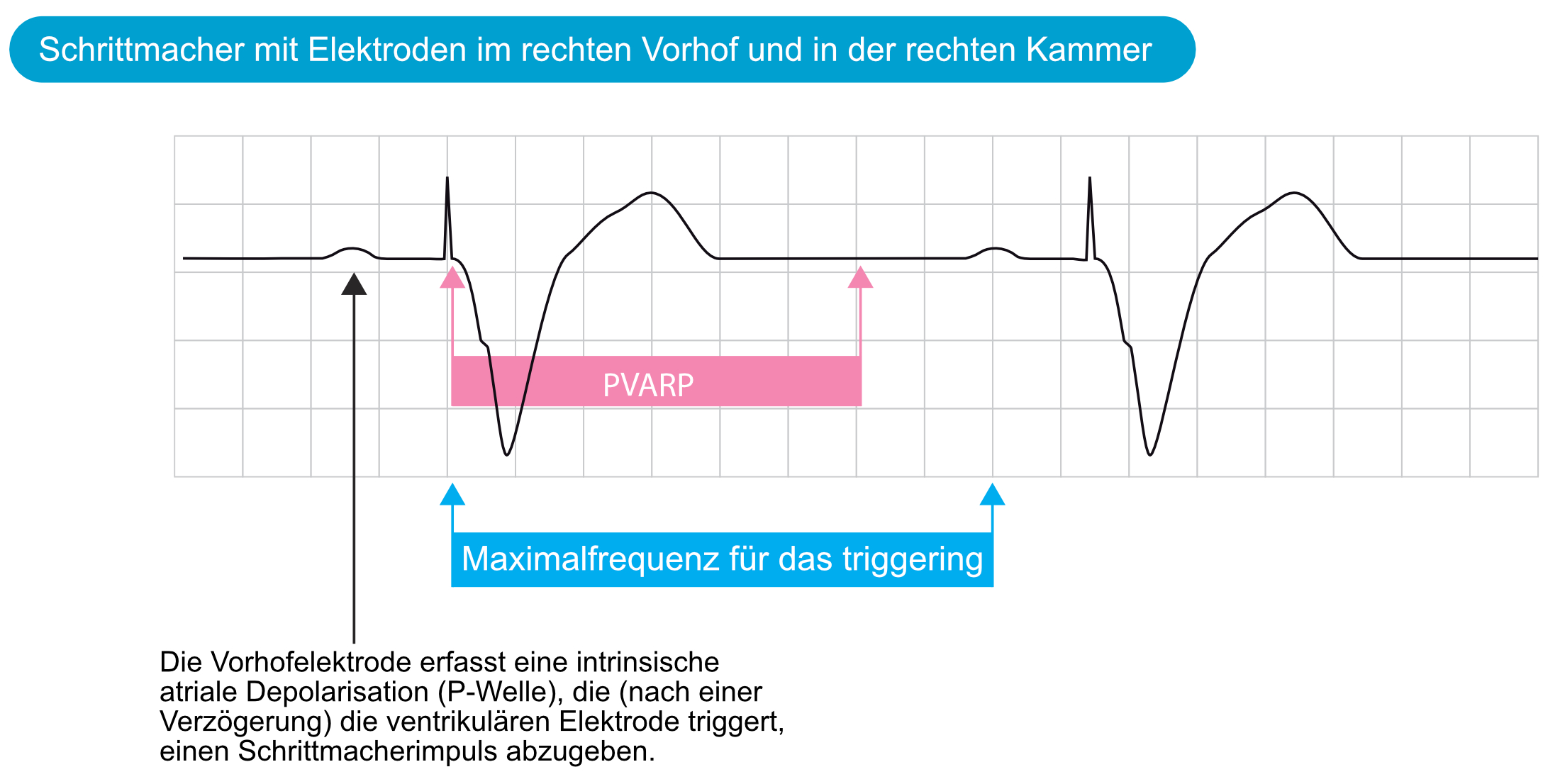 Abbildung 1. Während der PVARP ist die Vorhofelektrode refraktär, was bedeutet, dass die Reizerfassung ausgeschaltet ist. Der Zeitraum, der die Maximalfrequenz für das triggering illustriert, wird ebenfalls dargestellt.