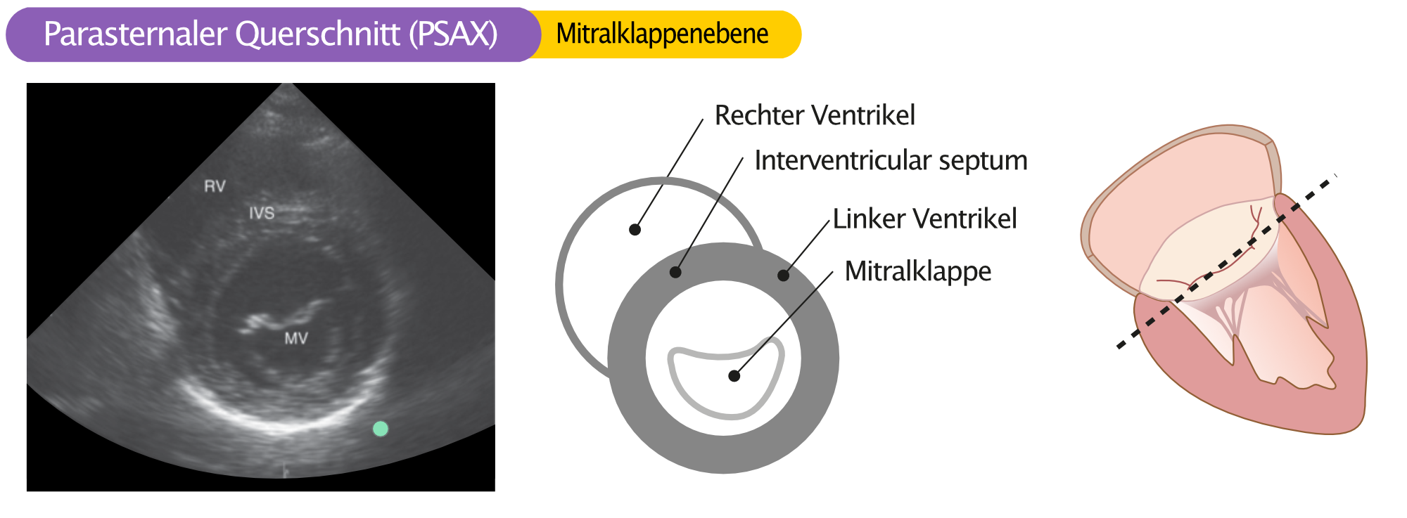 Abbildung 8. Parasternale kurze Achse in der Mitralklappenebene.