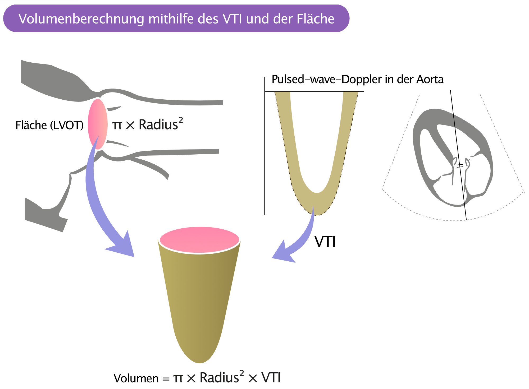 Abbildung 3. Darstellung der VTI in der Aortenöffnung im pulsed-wave-Doppler.
