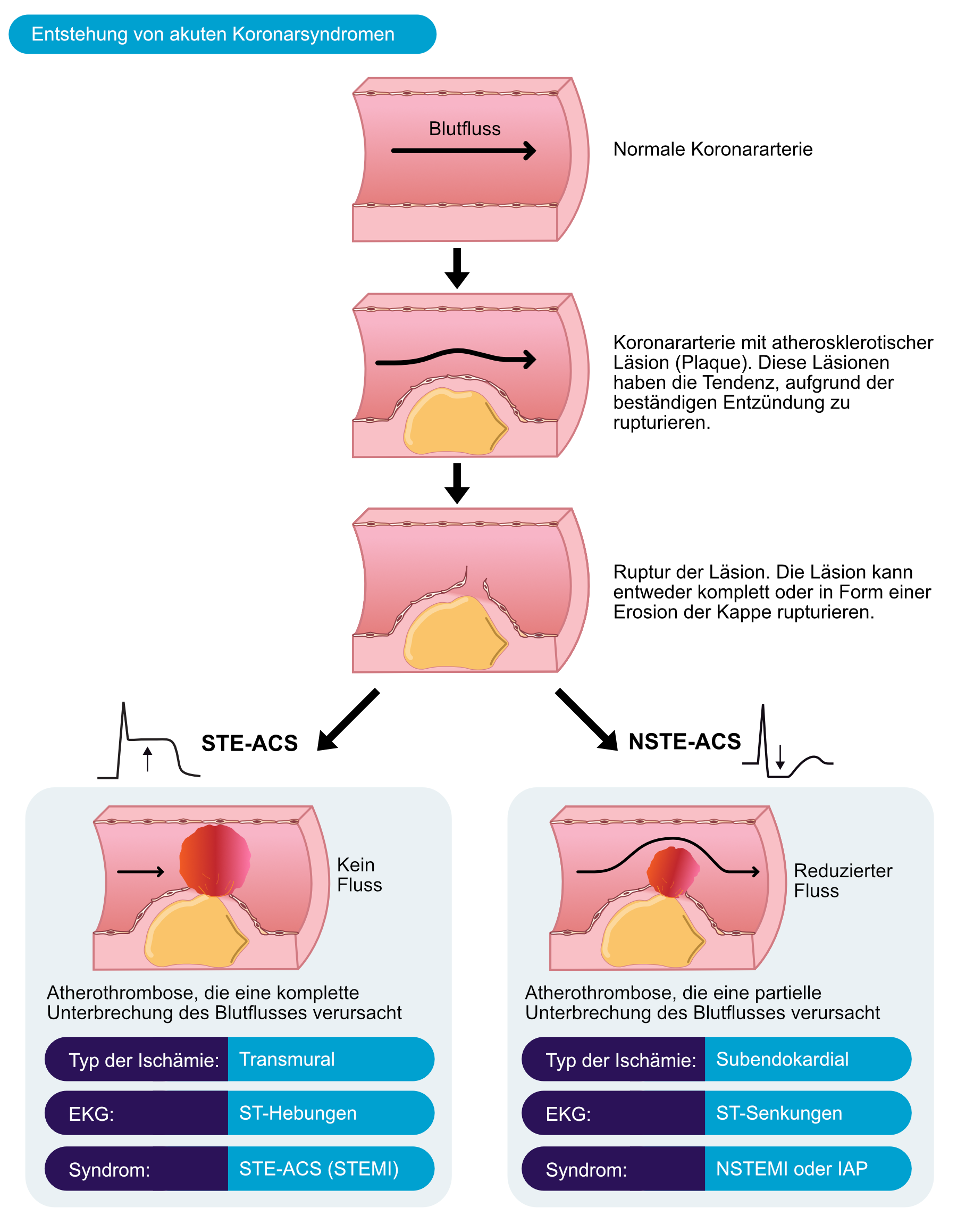 Abbildung 1. Eine Ruptur der atherosklerotischen Läsion verursacht eine Atherothrombose, welche den koronaren Blutfluss abrupt verringert. Ein STE-ACS (STEMI) tritt auf, wenn der Verschluss komplett ist, während ein NSTE-ACS (NSTEMI und instabile Angina) auftritt, wenn der Verschluss partiell ist.