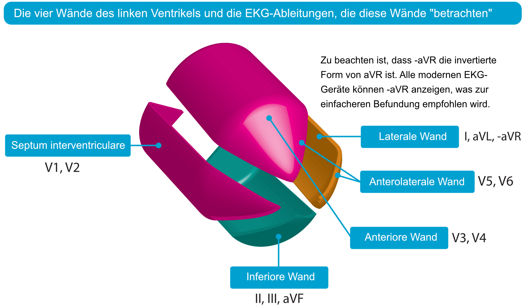 Abbildung 4. Die vier Wände des linken Ventrikels und der EKG-Ableitungen, die diese Wände widerspiegeln. Der Begriff „zusammenhängende Ableitungen“ bezieht sich auf zwei beliebige Ableitungen, die anatomische Nachbarn sind. Daher würde eine ST-Hebung in den Ableitungen V1 und V2 die Kriterien für einen ST-Hebungsinfarkt (STEMI) erfüllen. Eine ST-Hebung in V2 und V3 würde ebenfalls die Kriterien für einen ST-Hebungsinfarkt (STEMI) erfüllen, da diese beiden Ableitungen anatomische Nachbarn sind, auch wenn diese Abbildung zeigt, dass V2 die Septalwand und V3 die Vorderwand widerspiegelt.